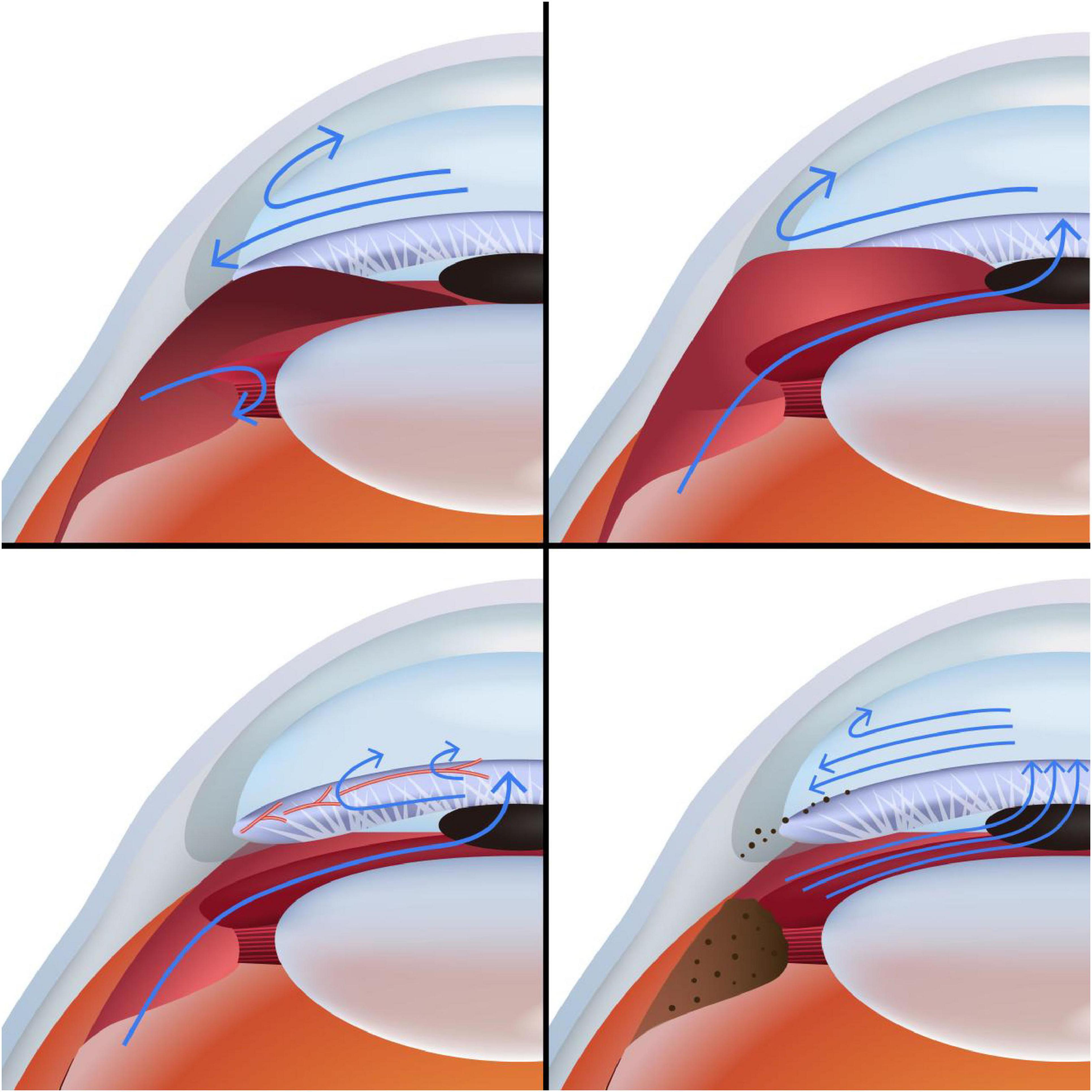 Illustration showing four eye anatomy diagrams with blue arrows indicating fluid flow or movement. Each quadrant highlights different aspects, such as circulation patterns, across eye structures like the lens and cornea. The diagrams are color-coded with shades of blue, red, and orange to differentiate anatomical features.