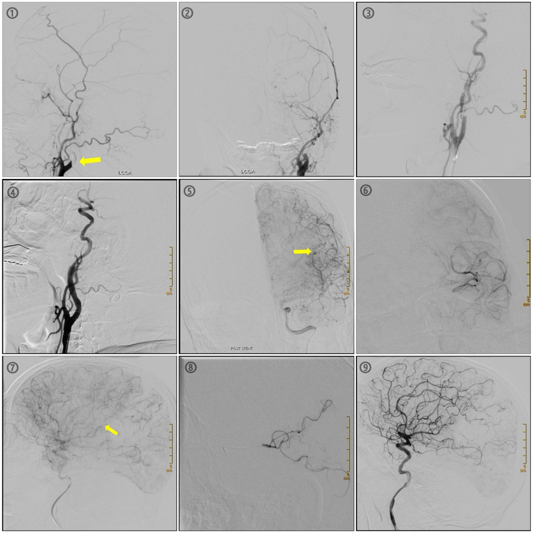 Illustrates the endovascular treatment process for a patient with serial lesions in a stroke. Images 1-4 depict the recanalization process of the extracranial segment of the internal carotid artery, while Images 5-8 show the recanalization process of intracranial occlusions.