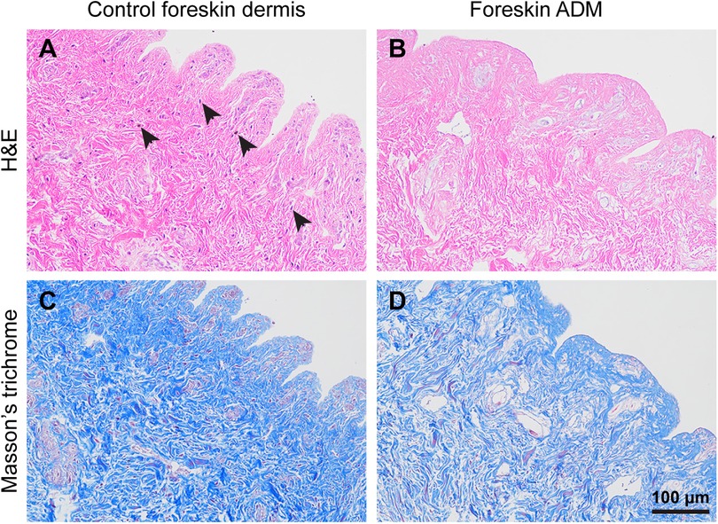 Histological comparison of control foreskin dermis and foreskin acellular dermal matrix (ADM) using H\&E and Masson's trichrome staining. Panel A (H\&E) shows intact dermal papillae with arrows indicating structural features in control tissue, while panel B shows reduced papillary structure in foreskin ADM. Panels C and D (Masson's trichrome) highlight collagen content, with panel C showing dense, organized collagen in control tissue and panel D showing looser, less organized collagen in foreskin ADM. Scale bar indicates 100 micrometers.