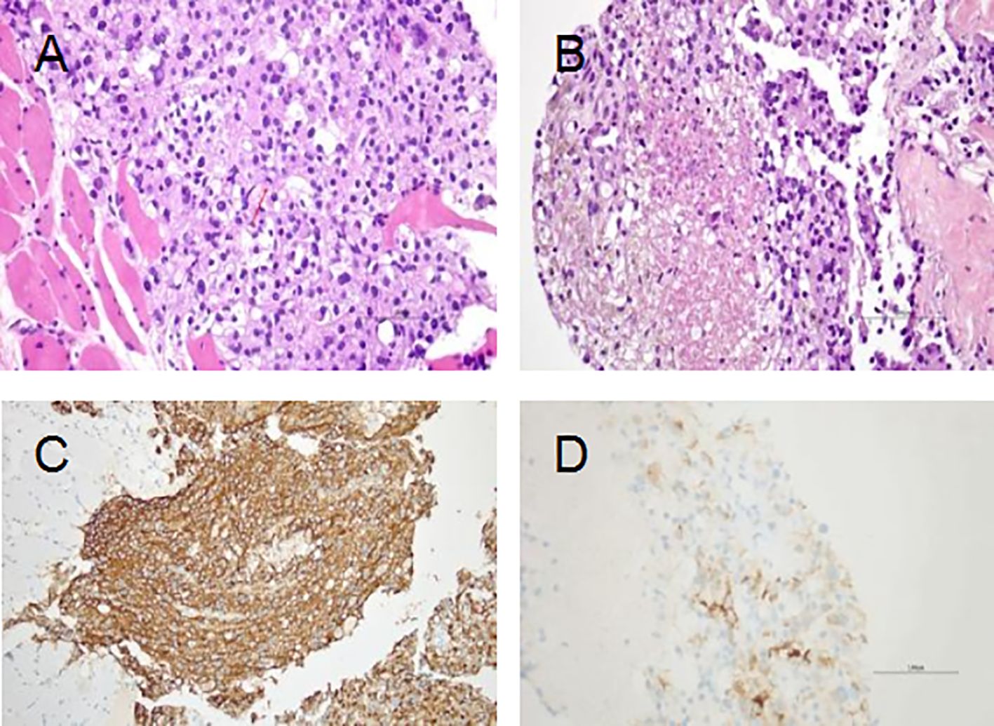 Four-panel microscopy images labeled A, B, C, and D. Panel A shows a dense arrangement of cells with pink and purple hues. Panel B displays a similar cellular structure with a lighter pink shade. Panel C features cells stained brown, indicating certain protein presence. Panel D highlights a sparse arrangement of cells with faint brown staining on a light background.