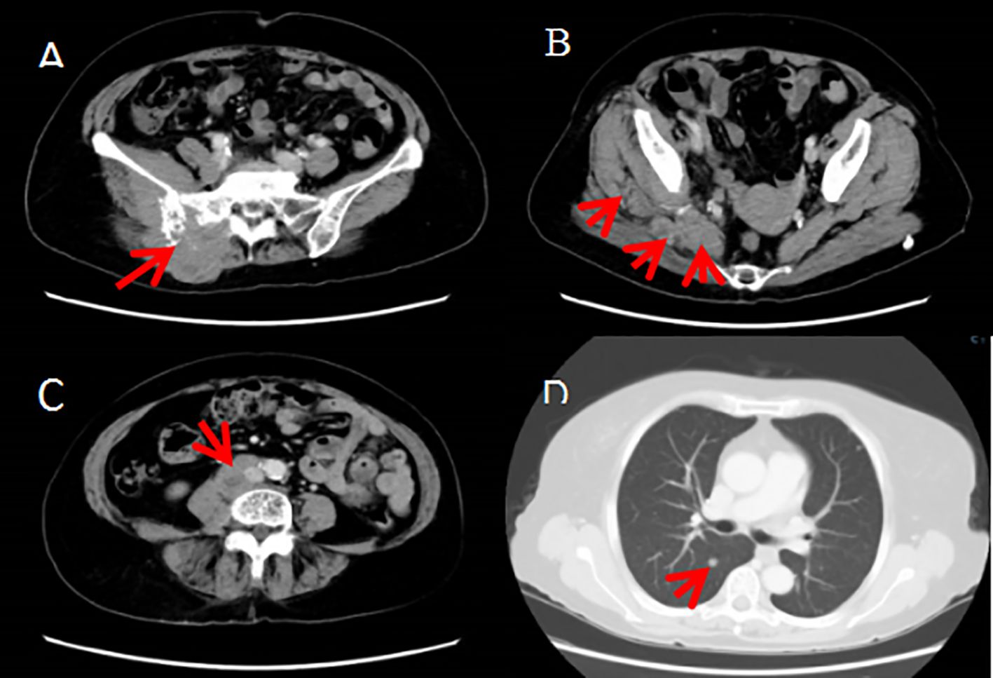 CT scans labeled A to D show different body sections with red arrows indicating specific areas of interest. A highlights the lower abdominal region. B focuses on the pelvic area. C centers on the mid-abdominal region. D shows a cross-section of the chest. Each arrow points to a highlighted anomaly or structure in these regions.