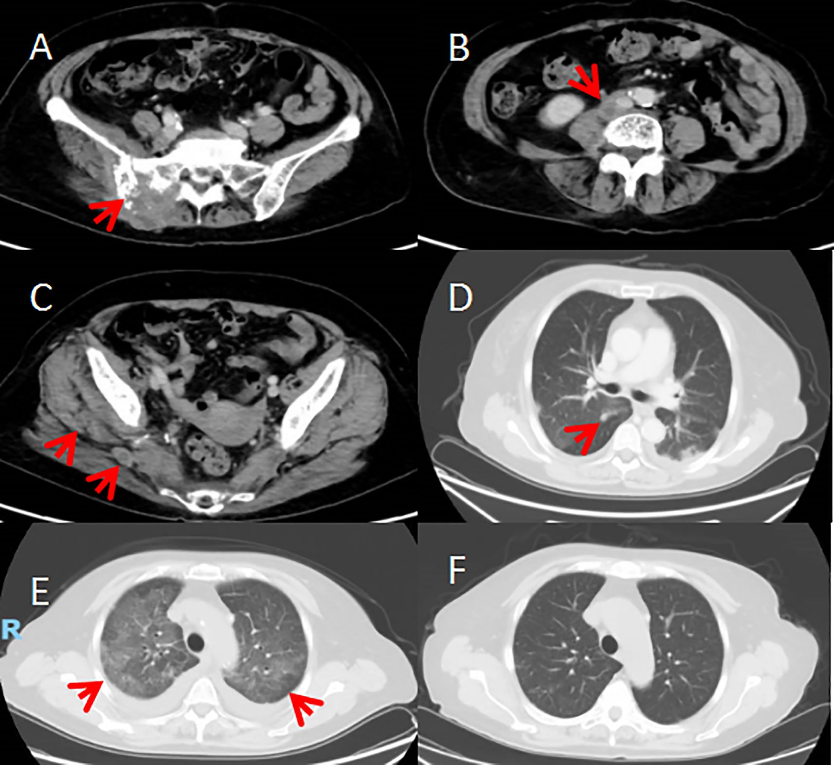 Six-panel medical imaging shows axial CT scans. Panels A and B focus on the abdominal area with red arrows indicating irregularities. Panel C highlights two areas with arrows. Panel D shows a lung scan with an arrow pointing to a highlighted region. Panel E displays arrows pointing to areas in both lungs. Panel F is a lung scan without annotations.