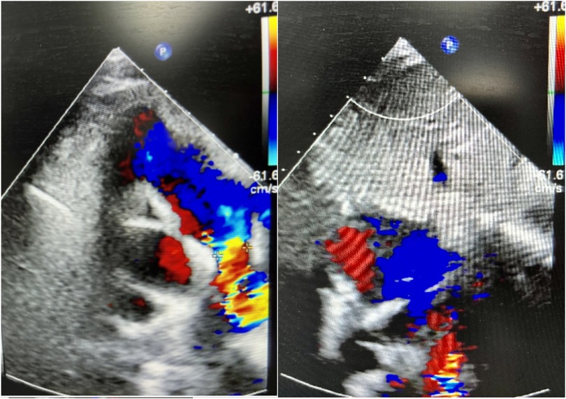 Two color Doppler echocardiogram images show blood flow in a heart. The images use red and blue colors to indicate the direction and speed of blood flow within the heart chambers and valves.