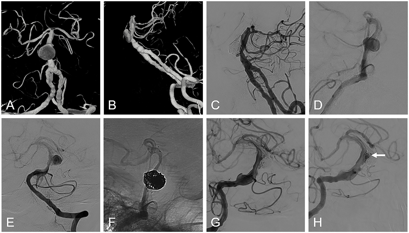 Flowchart detailing the classification and treatment of patients with different types of aneurysms. It starts with 395 patients with posterior circulation aneurysm, subdividing into 193 with vertebrobasilar aneurysm and further into 106 with basilar trunk aneurysm. Among these, 90 patients received endovascular treatment, specifying techniques like stent-assisted coiling and flow diversion.