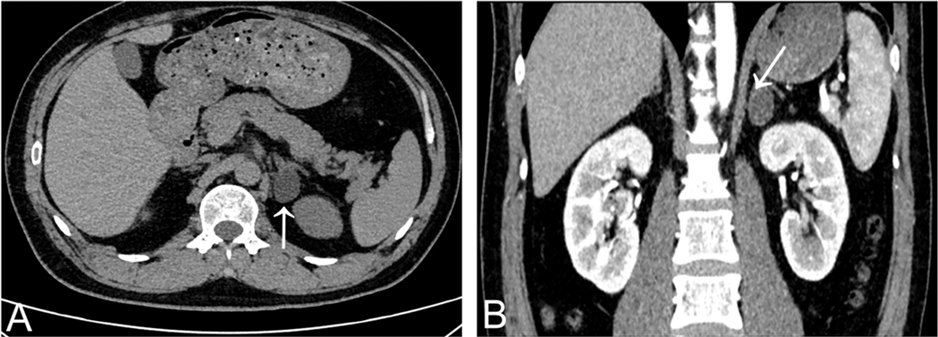 Two-panel CT scan displays abdominal images. Panel A shows a cross-sectional view with a white arrow pointing to a significant area near the spine. Panel B presents a coronal view highlighting the same region, also indicated by a white arrow.
