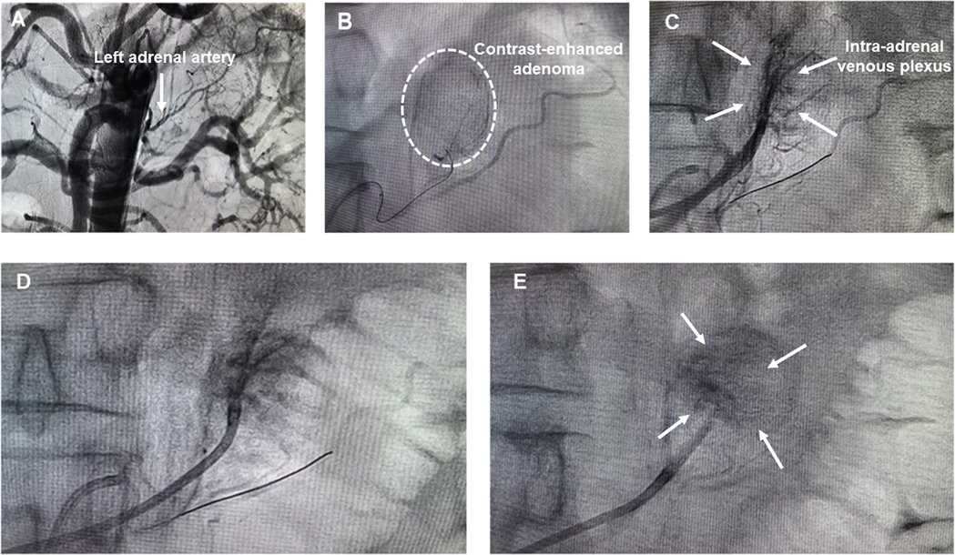 Panel A shows an angiogram highlighting the left adrenal artery. Panel B displays a contrast-enhanced adenoma enclosed by a dashed circle. Panel C illustrates the intra-adrenal venous plexus with labeled arrows. Panel D shows a catheter navigating towards the target area. Panel E highlights the targeted region with multiple arrows indicating the surrounding area.