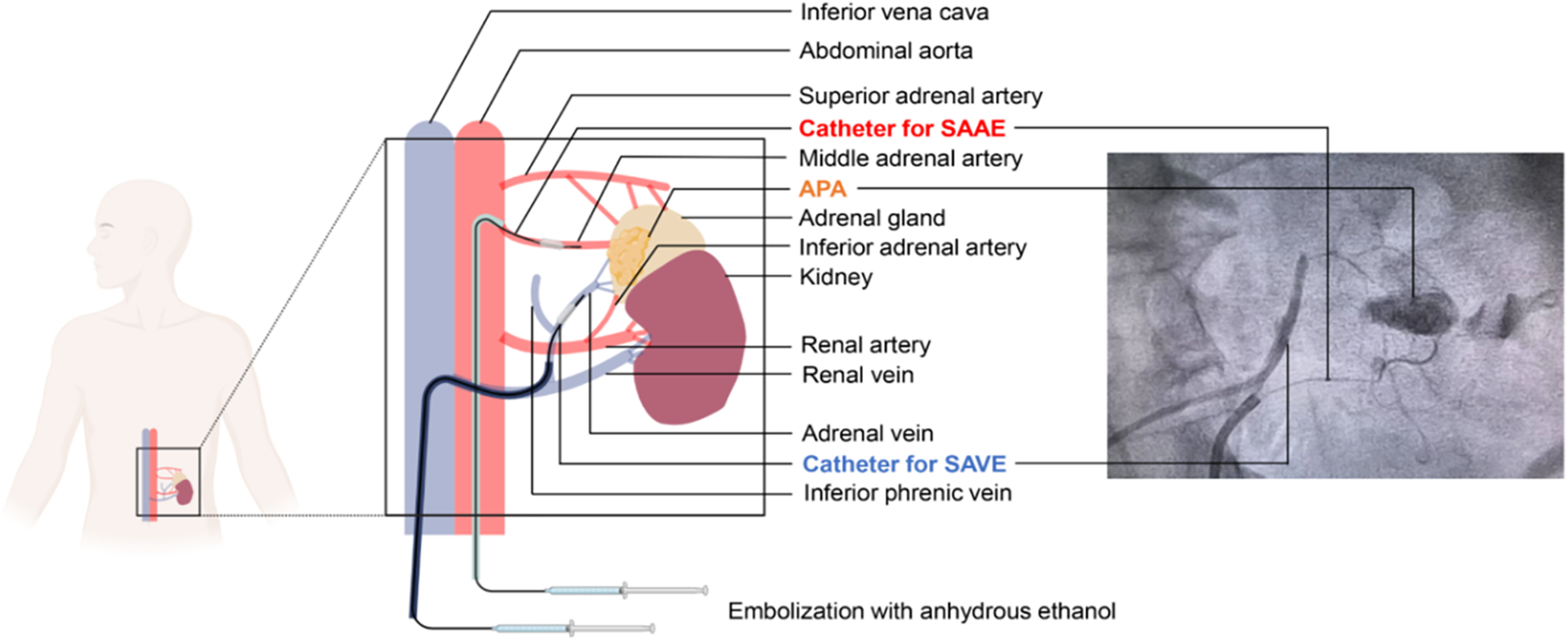 Diagram showing the placement of catheters for SAAE and SAVE procedures in the abdominal area, highlighting key vessels: inferior vena cava, abdominal aorta, renal artery and vein, adrenal gland, and phrenic vein. An inset image shows an X-ray view. The process involves embolization with anhydrous ethanol.