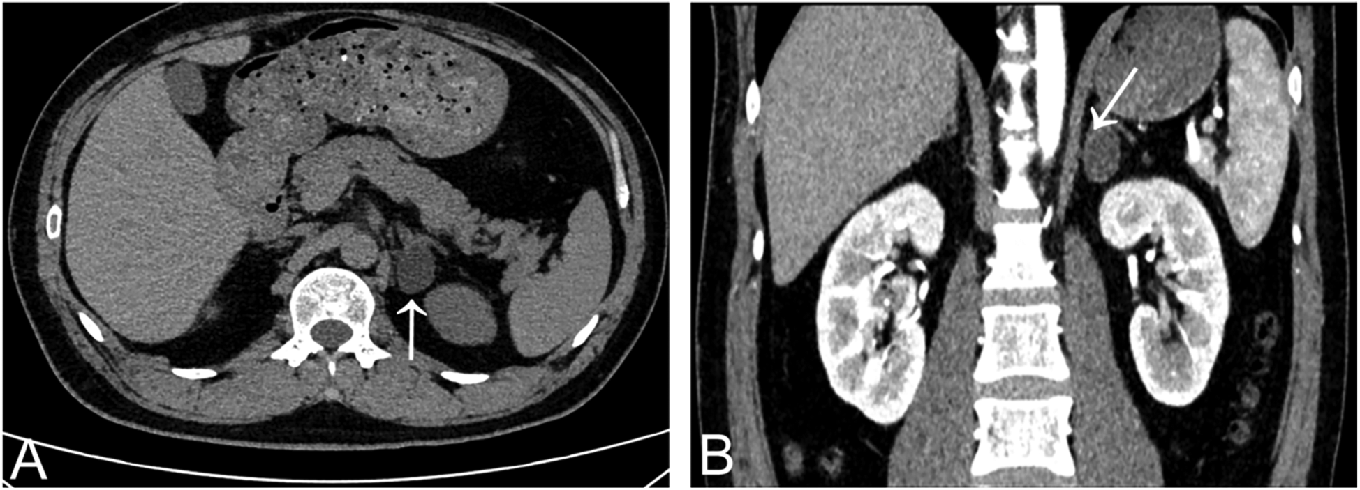 Two-panel CT scan displays abdominal images. Panel A shows a cross-sectional view with a white arrow pointing to a significant area near the spine. Panel B presents a coronal view highlighting the same region, also indicated by a white arrow.
