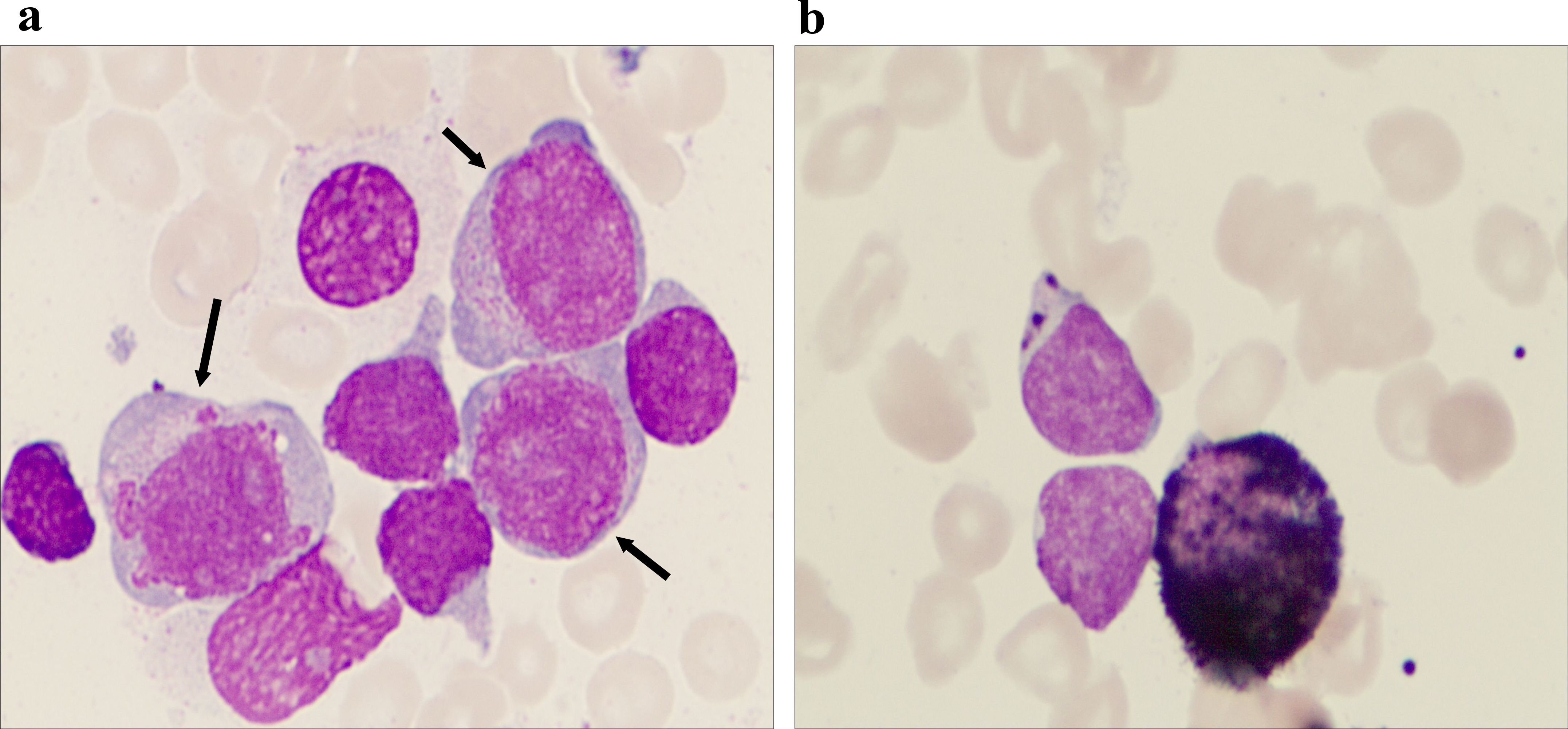 Panel a depicts a group of large, purple-stained cells with arrows indicating specific ones, suggesting an abnormality. Panel b shows fewer, similarly stained cells against a lighter background, focusing on cell morphology.