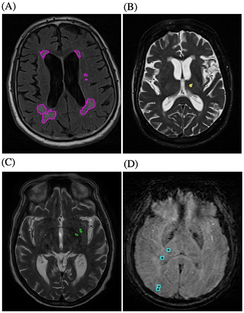 MRI brain scans showing segmented SVD markers: A) white matter hyperintensities (purple), B) lacunes (yellow), C) perivascular spaces (green), and D) microbleeds (blue).