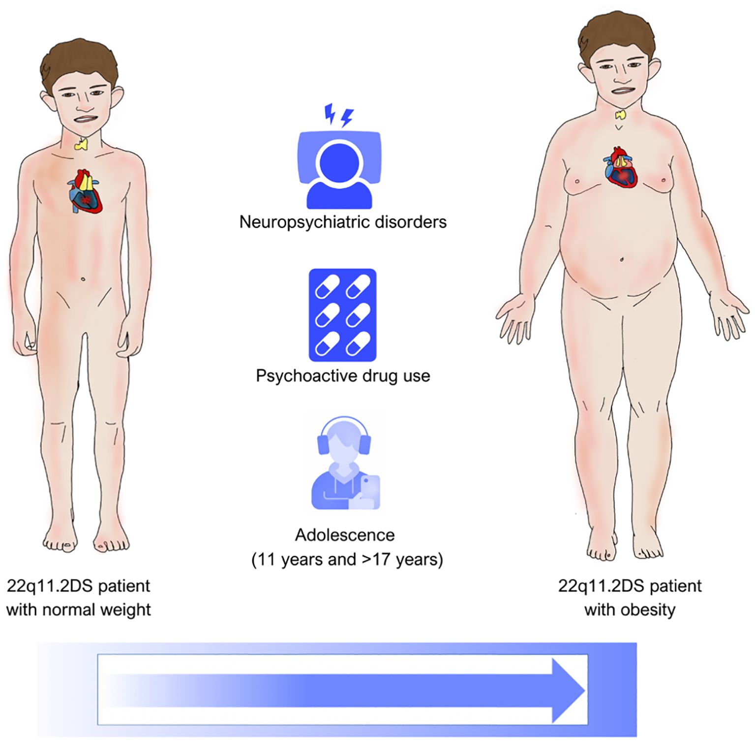 Illustration comparing two 22q11.2DS patients: one with normal weight and one with obesity. In the center are icons representing neuropsychiatric disorders, psychoactive drug use, and adolescence (ages eleven and over seventeen). A blue right-pointing arrow is shown below, indicating progression or development.