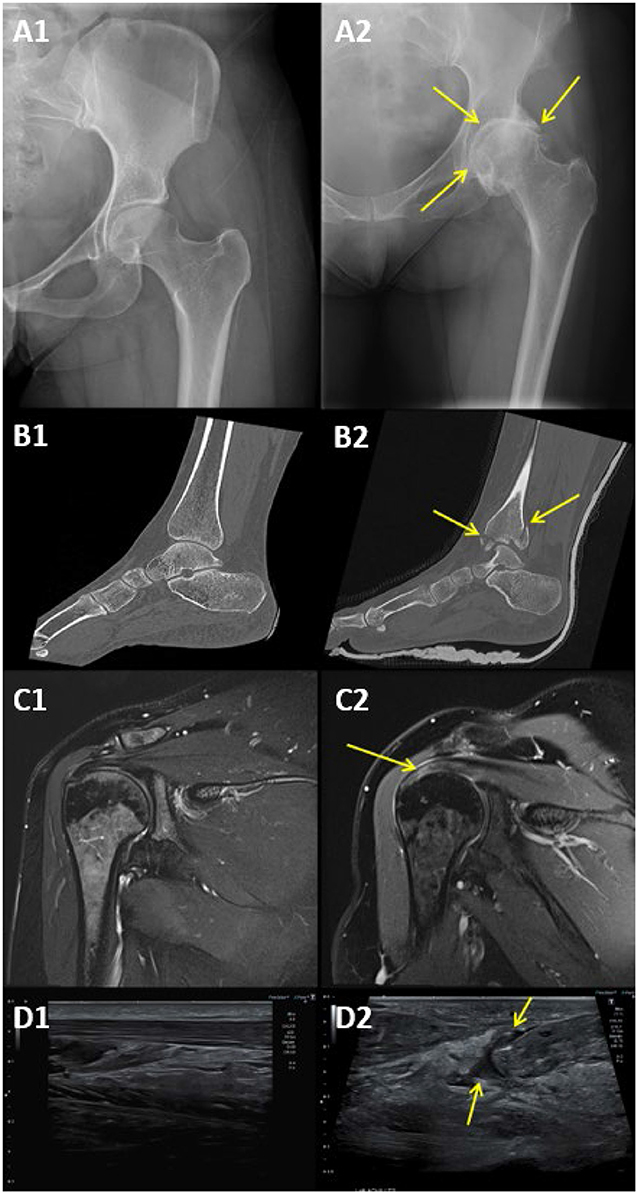 X-ray and MRI images display different joints with arrows pointing to specific areas. A1 and A2 show hip X-rays; A2 has arrows indicating Abnormalities caused by osteoarthritis. B1 and B2 present ankle scans, with B2 highlighting specific points that represent fractures. C1 and C2 are shoulder MRI images, with an arrow on C2 marking an area of tendon degeneration. D1 and D2 depict ultrasound scans, D2 has arrows pointing to an Achilles tendon rupture.