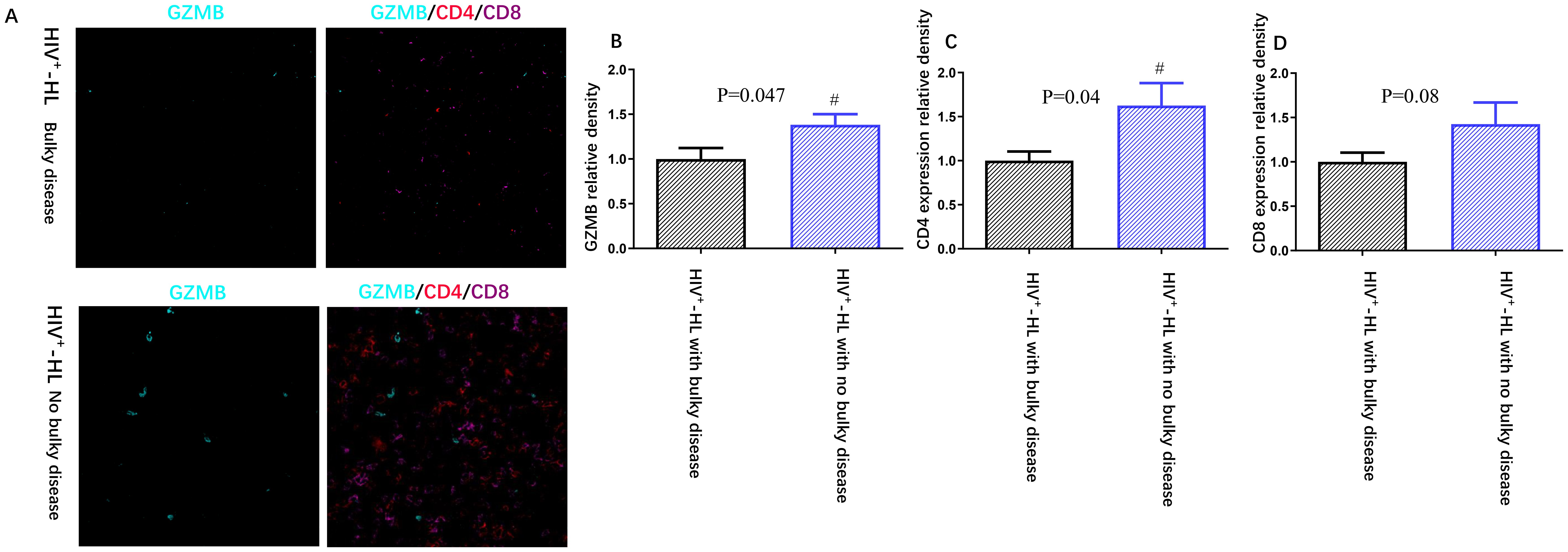 Fluorescence images and bar graphs comparing GZMB, CD4, and CD8 expression in HIV-positive Hodgkin lymphoma tissues. Upper images show samples with bulky disease; lower images, without. Right graphs display GZMB, CD4, and CD8 expression levels, with significant increases in non-bulky disease cases. Statistical significance indicated by P-values and hash symbols.