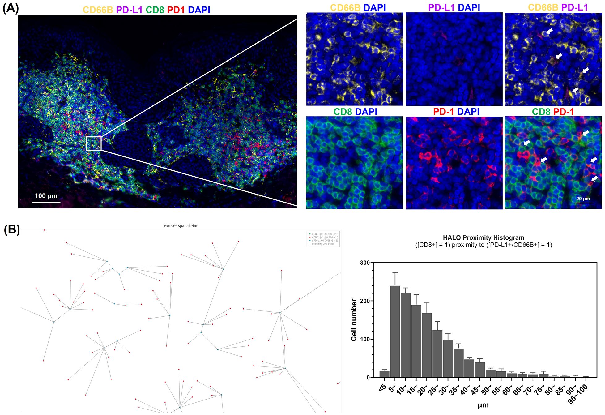 Multipanel image showing immunofluorescence and spatial analysis. Panel A highlights specific markers: CD66B (yellow), PD-L1 (magenta), CD8 (green), PD-1 (red), with DAPI (blue) for nuclei. Detailed views show co-localization of markers. Panel B includes a HALO spatial plot depicting cell proximity and a histogram showing CD8+ cell numbers within varying distances to PD-L1+ and CD66B+ cells, ranging from less than 5 micrometers to 95-100 micrometers. Arrows highlight specific interactions between markers.