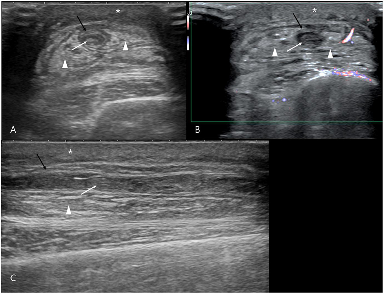 Three ultrasound images labeled A, B, and C illustrate chemotherapy-induced phlebitis in the right cephalic vein. Panel A (transverse view) shows subcutaneous edema beneath the skin, indicated by asterisks, and fat edema surrounding the vein. Panel B (color Doppler) demonstrates altered vascular flow with highlighted regions of reduced perfusion. Panel C (sagittal view) depicts irregular thickening of the venous wall, marked by black arrows, along with heterogeneously hyperechoic intraluminal thrombi, indicated by white arrows. Together, these images highlight characteristic ultrasonographic features of phlebitis, including edema, vessel wall irregularity, and thrombus formation, with labeled symbols guiding interpretation.
