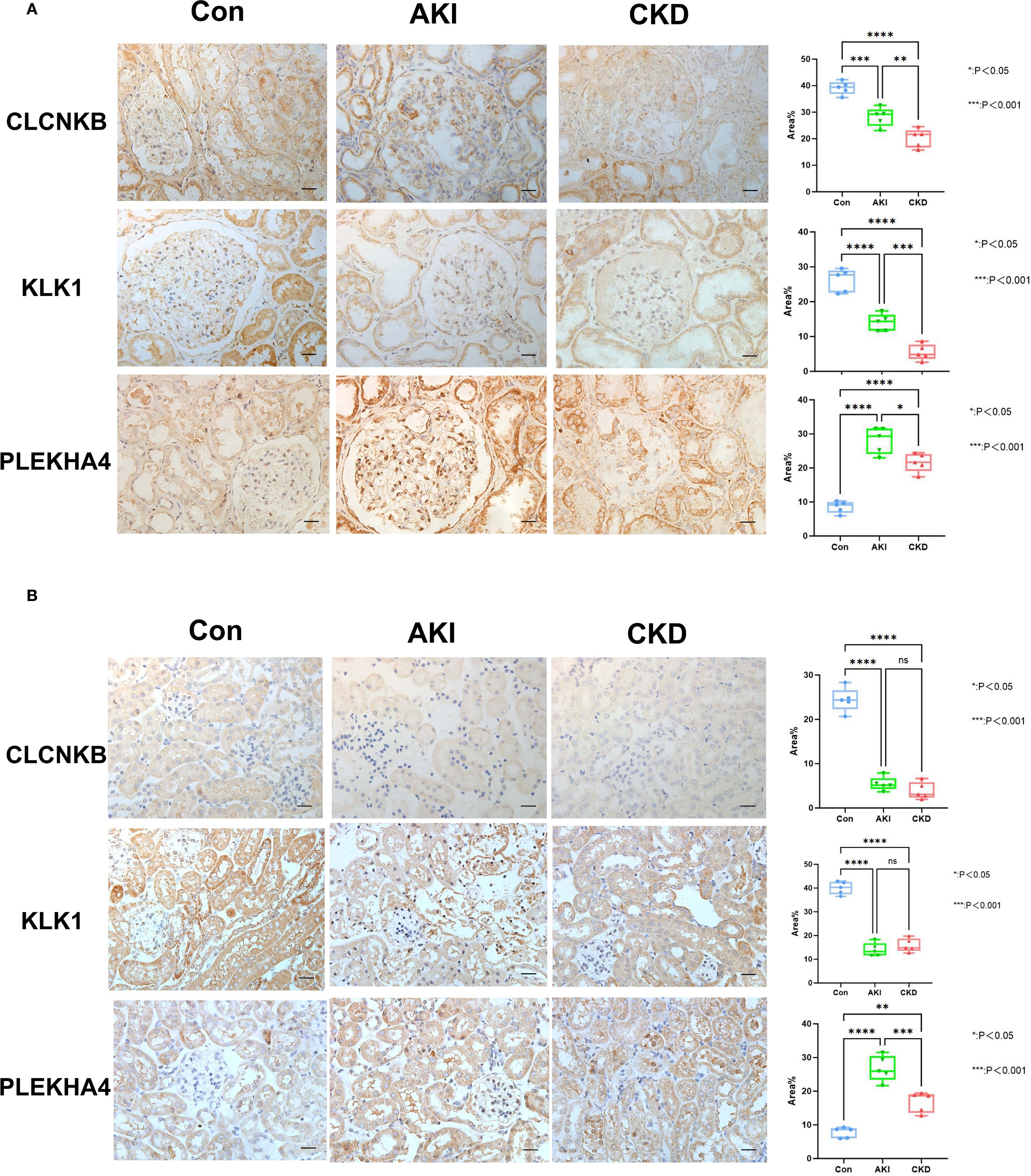 Two panels (A and B) show kidney tissue images and box plots for CLCNKB, KLK1, and PLEKHA4 expression under control (Con), acute kidney injury (AKI), and chronic kidney disease (CKD) conditions. Staining intensity varies among conditions. Box plots on the right display statistical differences in expression levels, with significant p-values indicated.