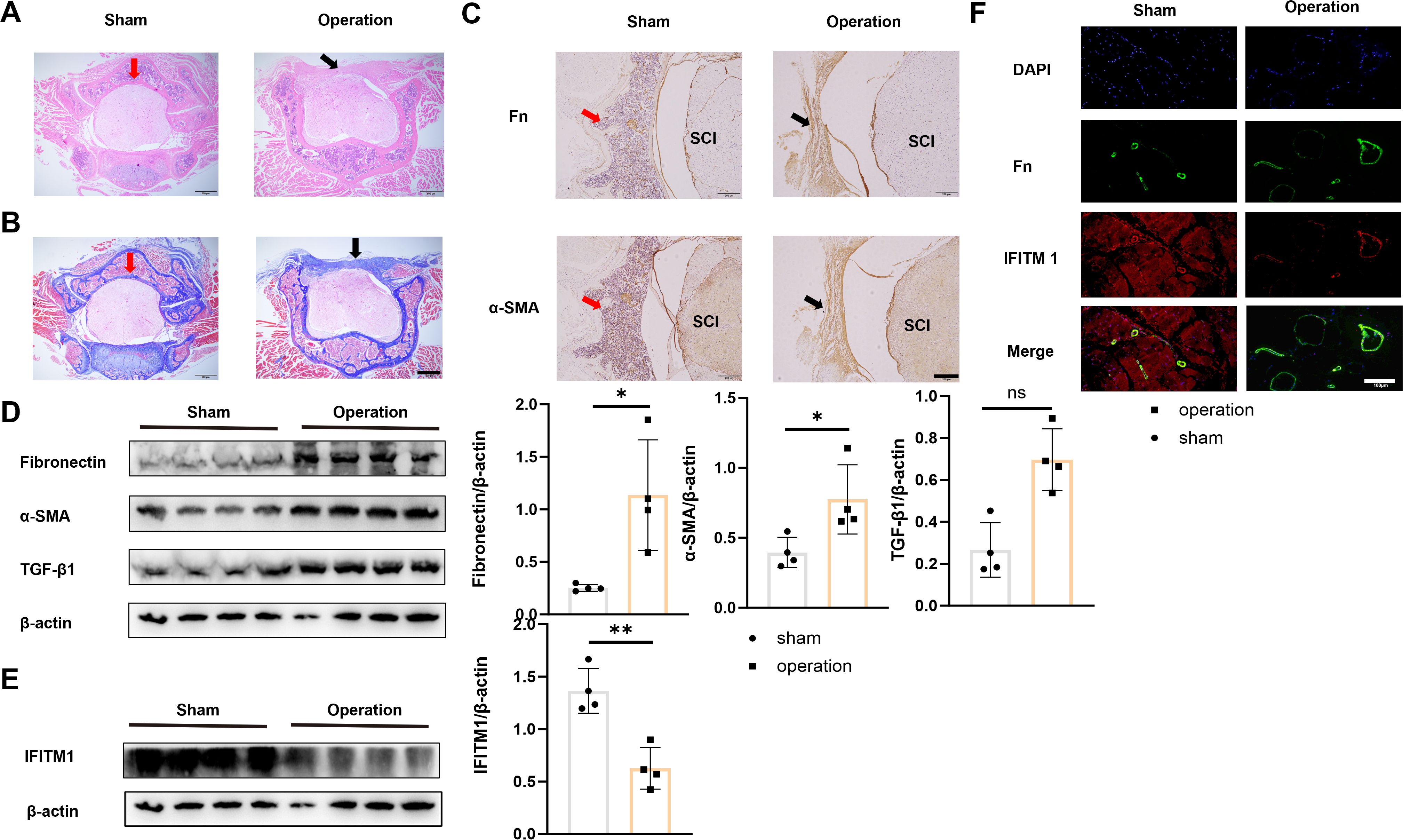 Histological and biochemical analysis image shows comparative assessments between sham and operation groups. Panels A and B display stained tissue sections with arrows highlighting key areas. Panel C highlights expression of fibronectin (Fn) and α-SMA, with histological sections labeled SCI. Panel D and E show Western blot results for fibronectin, α-SMA, TGF-β1, IFITM1, and β-actin with corresponding bar graphs indicating significant changes marked by asterisks. Panel F shows fluorescent staining with DAPI, fibronectin, IFITM1, and merged images, underscoring differences between sham and operation groups.