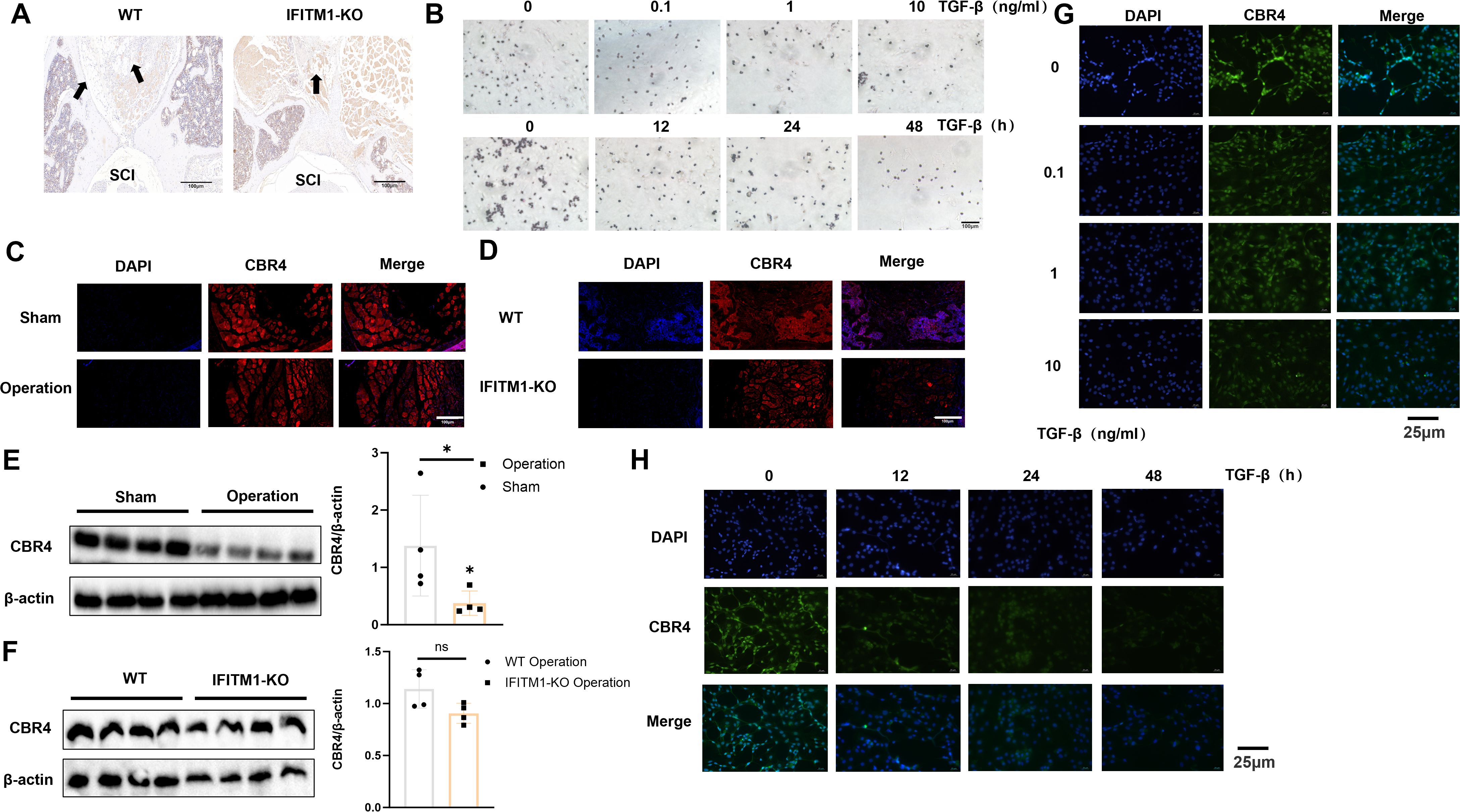Scientific image shows multiple panels with microscopy images and graphs related to a study on the expression of CBR4 in spinal cord injury. Panels A and D compare WT and IFITM1-KO conditions with arrows indicating specific areas. Panels B and G examine effects of TGF-β concentrations over time on cell cultures. Panels C and H display DAPI and CBR4 staining in sham and operation conditions. Panels E and F present Western blot analyses for CBR4 and β-actin, with graphs indicating expression levels. Scale bars are present in several images for reference. Overall, the figure explores CBR4 expression under various conditions.