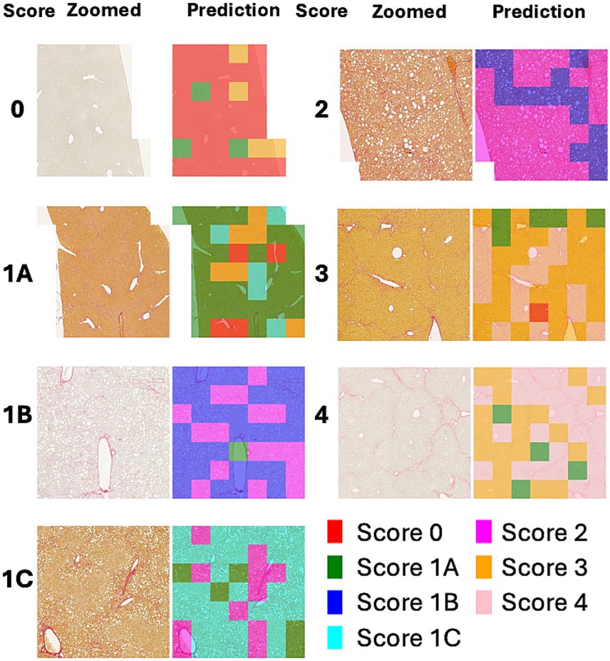 Microscopic images showing liver biopsy samples with corresponding color-coded prediction maps indicating fibrosis scores. Panels labeled 0, 1A, 1B, 1C, 2, 3, and 4 display tissue sections alongside prediction maps using colors: red for Score 0, green for Score 1A, blue for Score 1B, teal for Score 1C, magenta for Score 2, orange for Score 3, and pink for Score 4. Each row compares the zoomed-in biopsy image with the model's prediction zone using these scores.