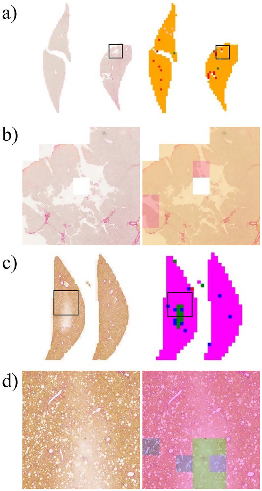 Four panels showing histological images and their processed versions. a) Two liver tissue sections, one processed with color-coded overlays highlighting features in orange, red, and green. b) Two liver tissue sections, one processed with translucent overlays. c) Two liver tissue sections, one processed with bright color overlays in pink and blue, highlighting specific regions. d) Two close-up views of liver tissue, one processed with overlays in multiple colors showing enhanced details.