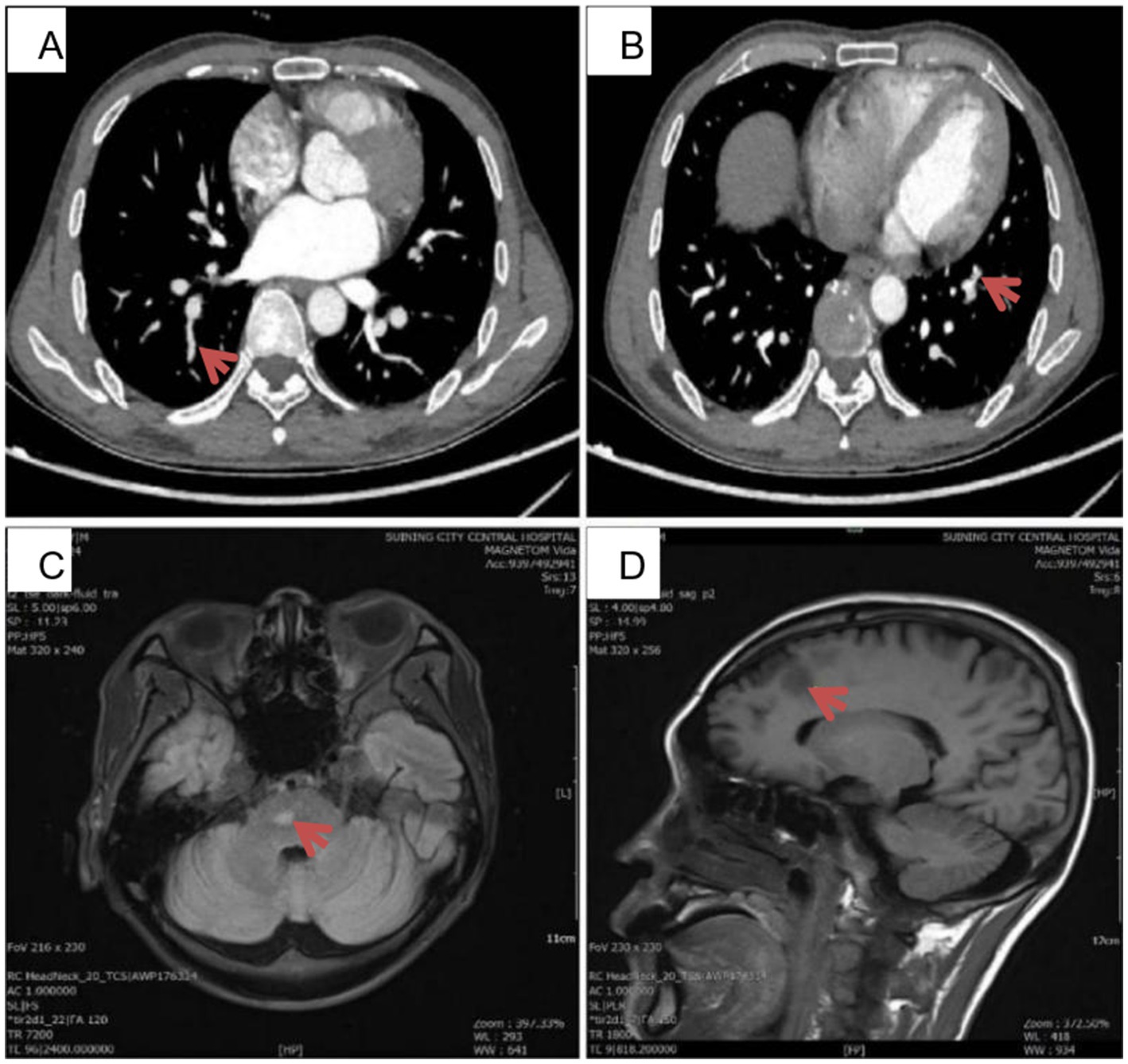 CT and MRI scans showing different views with red arrows indicating specific areas. Panel A and B display cross-sectional views of the thorax. Panel C shows an axial view of the brain. Panel D presents a sagittal view of the brain.