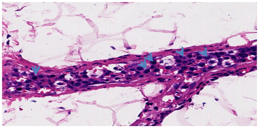 Histopathology image showing a section of bone marrow with clusters of large pale cells, marked by blue arrows, surrounded by smaller dark-stained cells. The background has a light pink hue.