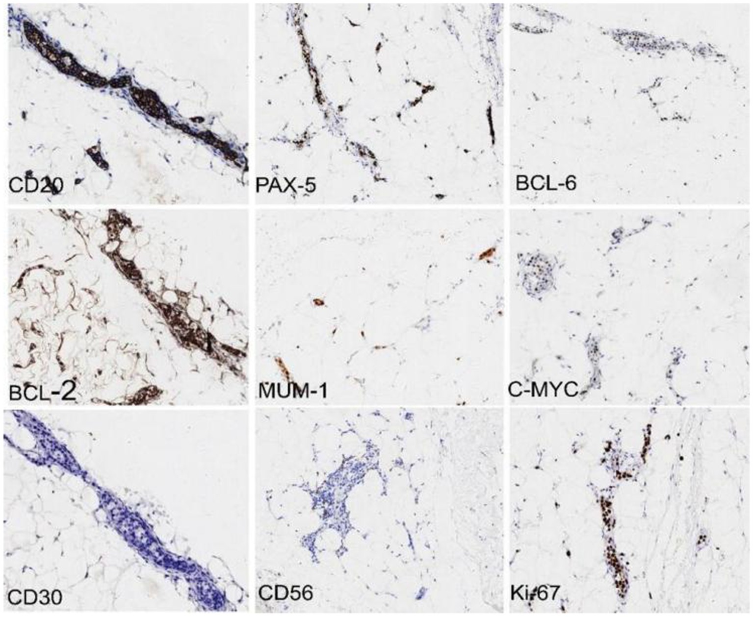 Nine-panel image showing stained microscopic slides labeled CD20, PAX-5, BCL-6, BCL-2, MUM-1, C-MYC, CD30, CD56, and Ki67. Each panel displays variable expression patterns of the respective markers on a white background, with darker areas indicating higher marker presence.