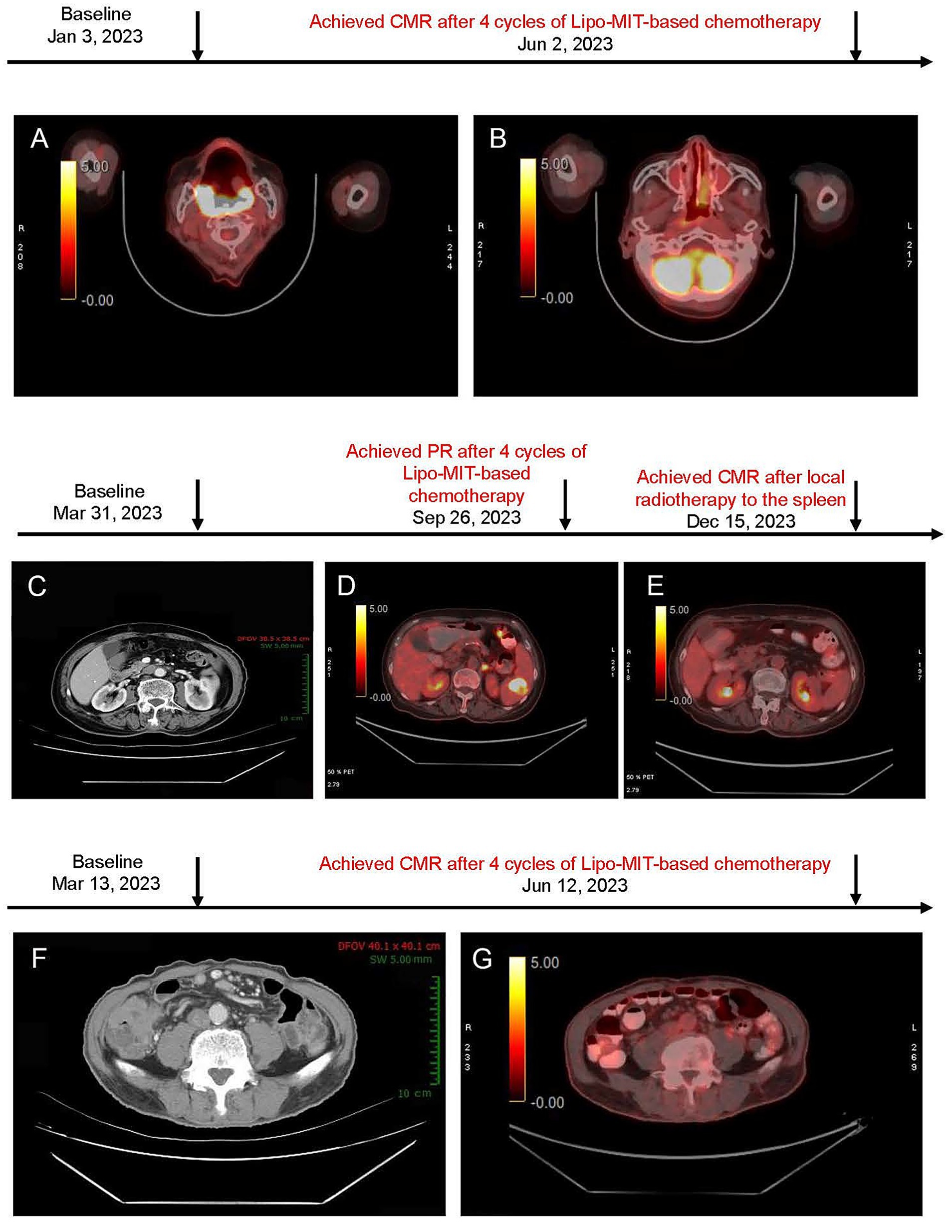 Medical imaging panels showing progression and treatment outcomes using Lipo-MiT-based chemotherapy and radiotherapy over various dates in 2023. Panels A and B of case 1 depict nasopharyngeal and cervical lesions, panels C, D, and E of case 2 show neck, chest, abdomen, and pelvis images, with panel E showing post-radiotherapy changes. Panels F and G of case 3 illustrate neck, chest, abdomen, and pelvis scans. The timeline indicates baseline scans and achieved responses, including complete metabolic response (CMR) and partial response (PR). Red, yellow, and black color scales are used in imaging to indicate different activity levels.