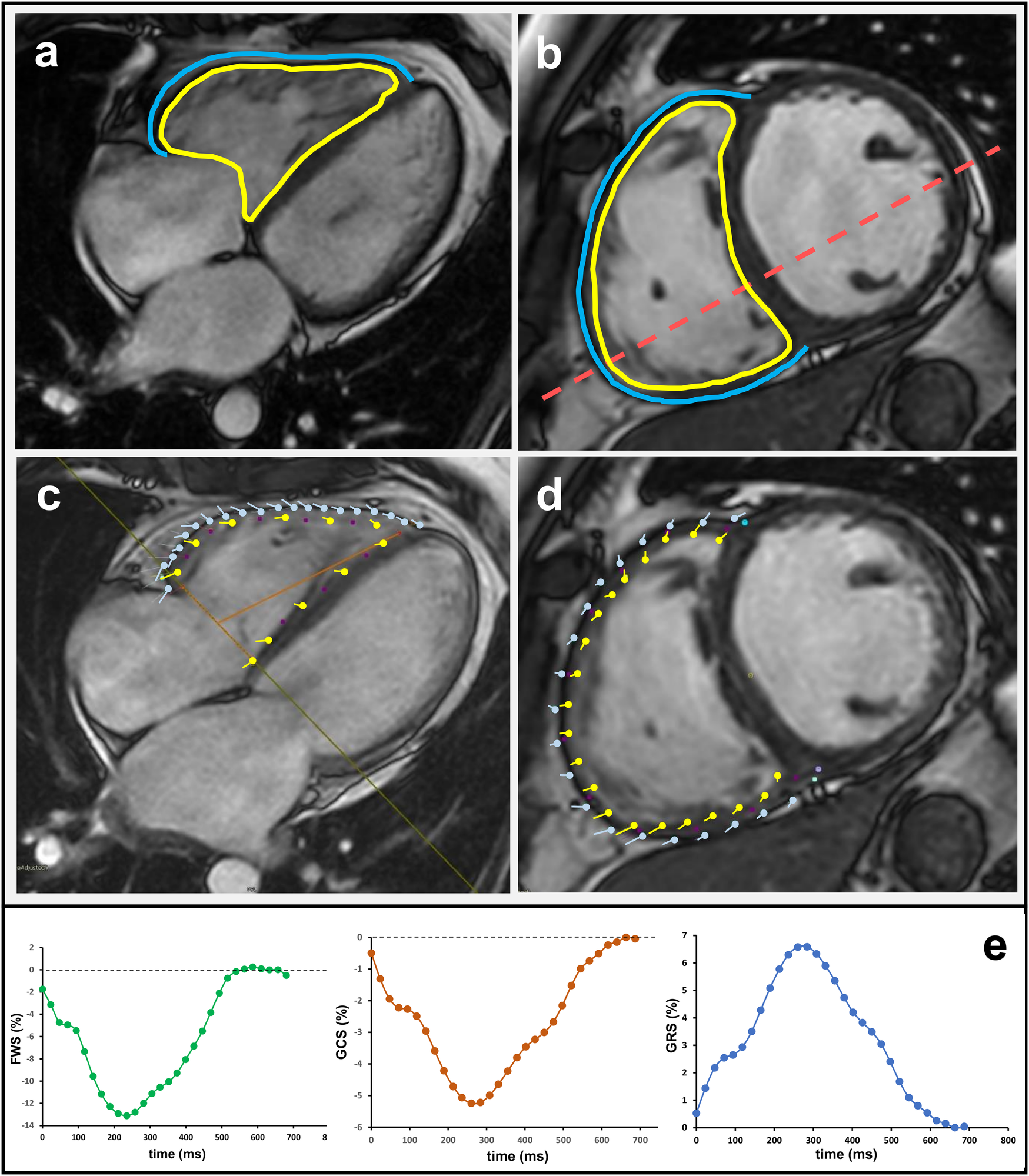 Panel of cardiac MRI images and strain analysis graphs. Panels a and b show endocardial (yellow) and epicardial (blue) contours of the left ventricle in four-chamber and short-axis views, respectively. Panels c and d display myocardial tracking with yellow and blue markers outlining motion across cardiac cycles. Panel e presents strain curves over time: fractional wall shortening (FWS), global circumferential strain (GCS), and global radial strain (GRS), illustrating myocardial deformation dynamics.