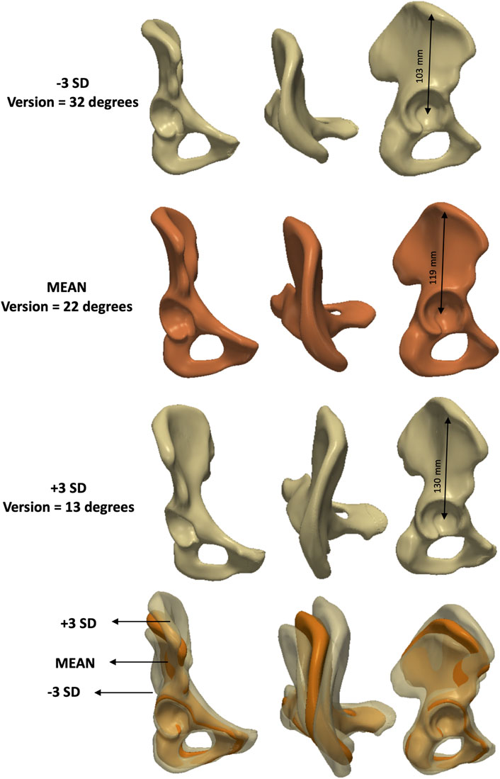 Three rows of 3D hip bone models showing different versions and elongations. Top row: −3 SD with 32 degrees version and 103 mm elongation. Midlle row: mean with 22 degrees version and 119 mm elongation. Bottom row: +3 SD with 13 degrees version and 130 mm elongation.