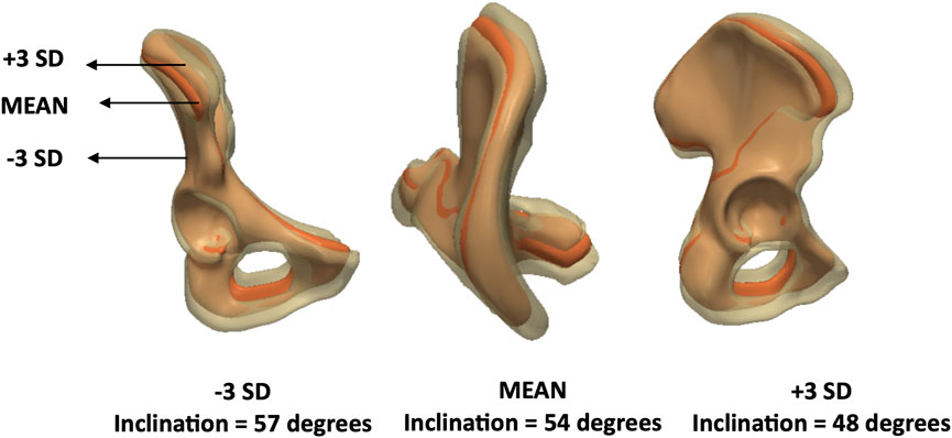 Three pelvic models showing variation in inclination: -3 SD with 57 degrees, mean with 54 degrees, and +3 SD with 48 degrees. Models are labeled by standard deviation with arrows.