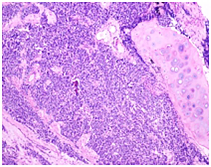 Histological image showing a section of tissue stained in shades of purple and pink. Dense cellular structures are visible on the left, while a lighter, more organized area appears on the right, suggestive of a different tissue type.