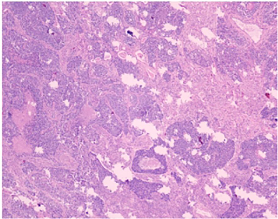 Microscopic view of tissue showing a complex structure with various shades of purple and pink. The image includes irregularly shaped areas of denser and lighter coloration, indicating different tissue types or components.