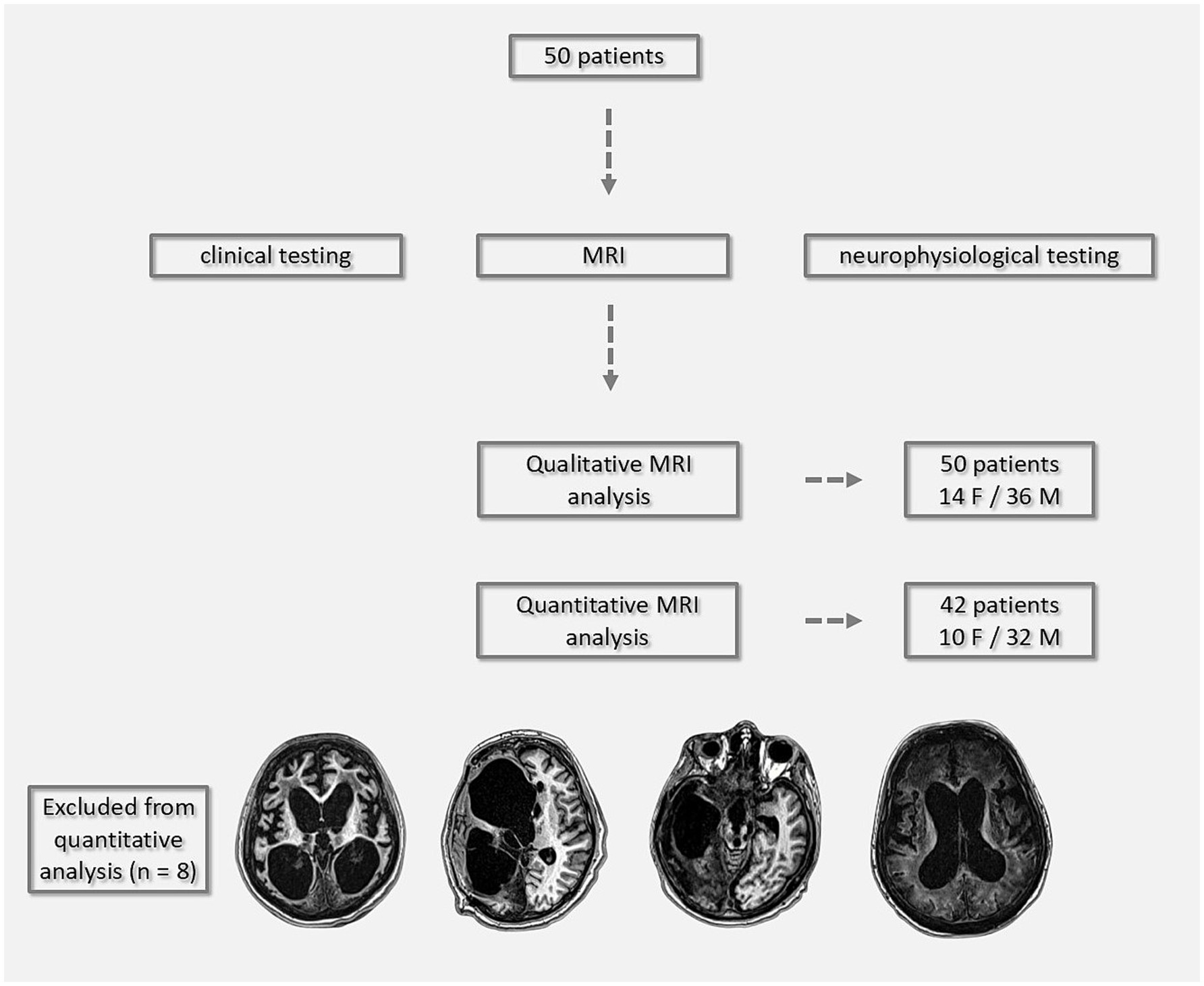 Flowchart depicting a study involving 50 patients undergoing clinical and neurophysiological testing, followed by MRI. Qualitative MRI analysis included all 50 patients (14 female, 36 male). Quantitative MRI analysis included 42 patients (10 female, 32 male), with eight excluded. Below are brain MRI images of excluded patients.