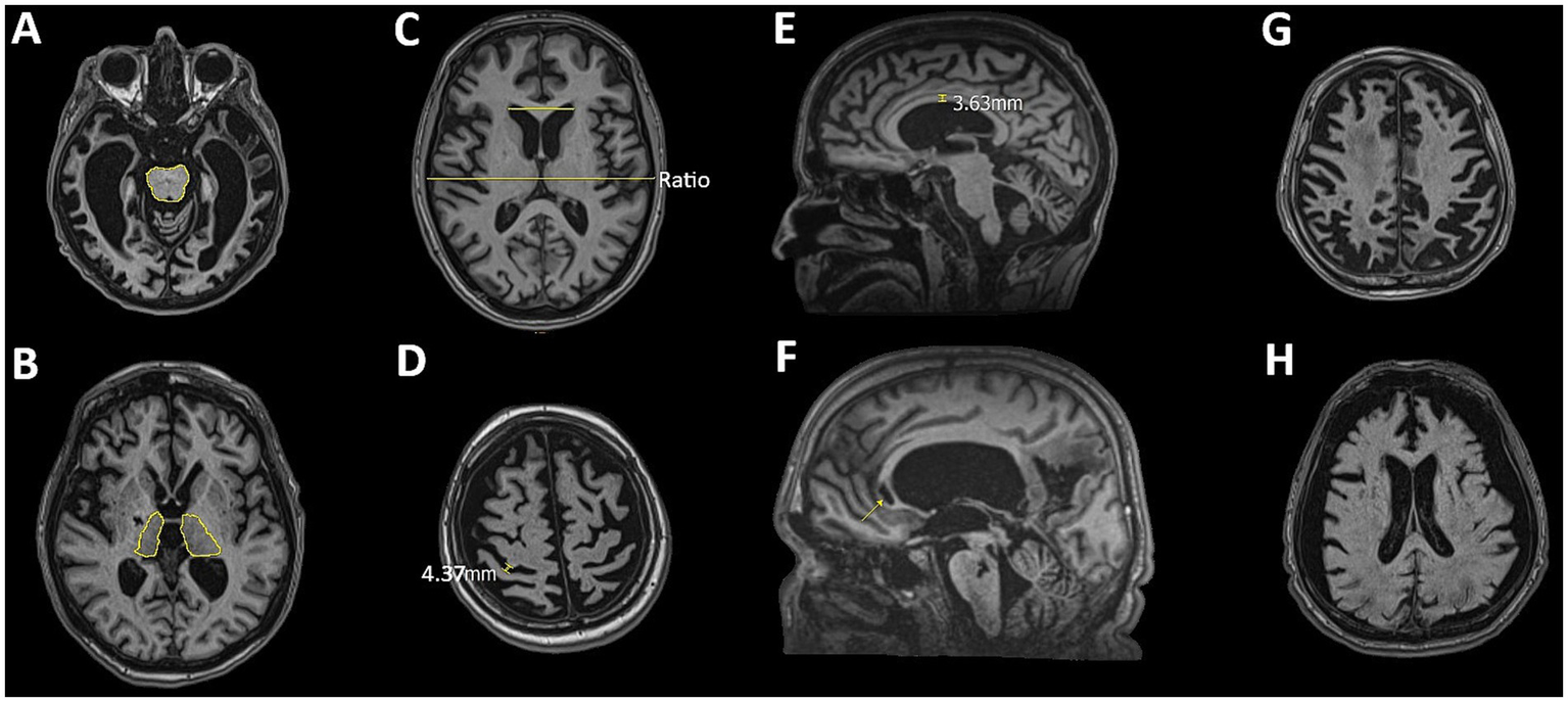 MRI brain scans labeled A to H show various slices and measurements. A and B highlight specific regions with yellow outlines. C shows a ratio measurement across structures. D measures 4.37 mm across a section. E indicates a 3.63 mm distance in a sagittal view. F has an arrow pointing to a lateral structure. G and H present additional axial slices, revealing brain morphology.
