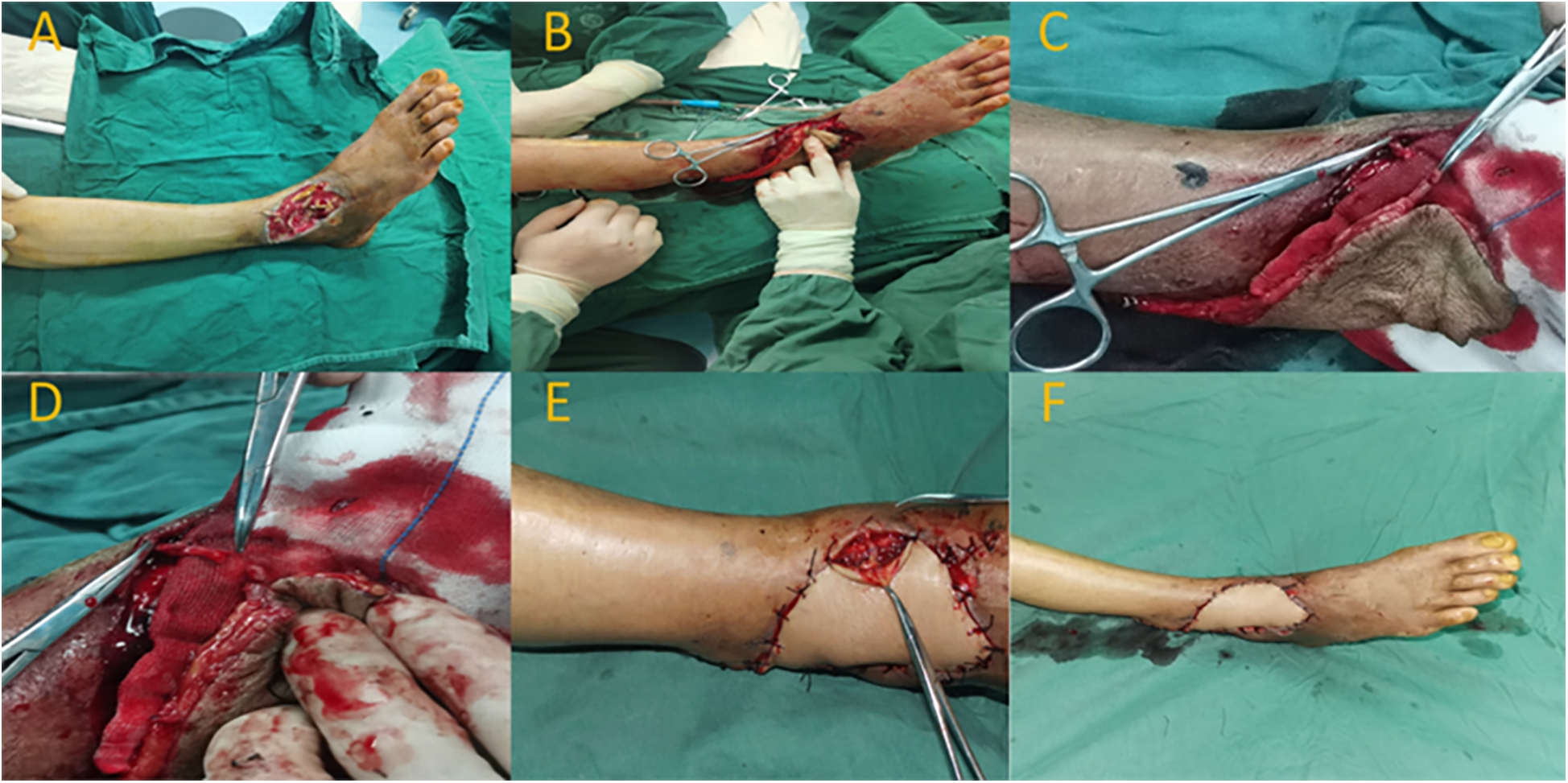 A series of six images depicting a medical procedure on a foot and leg. Image A shows an open wound on the foot. Image B displays surgeons working on the wound. Image C focuses on surgical instruments on the wound. Image D shows close-up stitching on a bloody wound. Image E depicts a stitched leg with a partially open wound. Image F shows a foot and leg after the procedure with visible stitches.