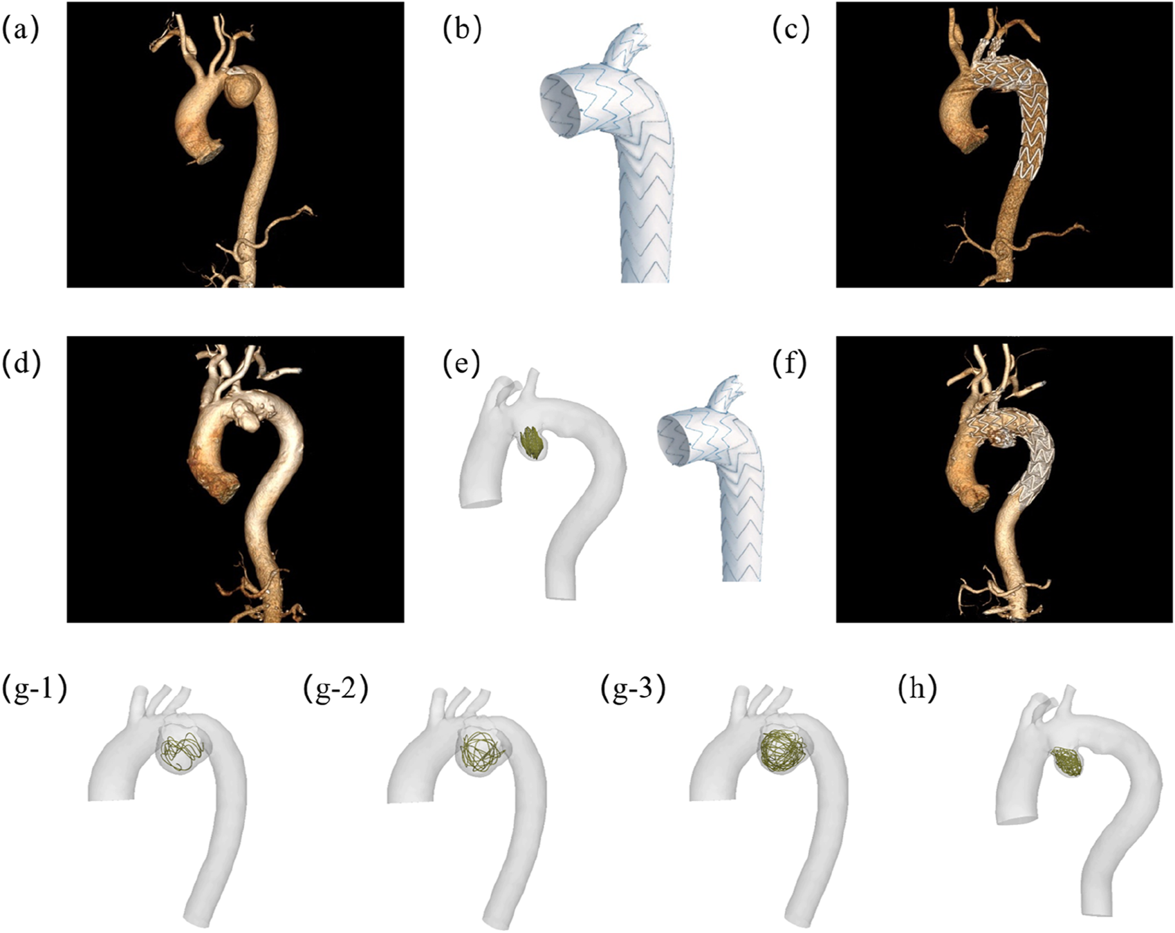 A series of eight panels illustrating different stages of aortic repair. Panel (a) and (d) show a 3D model of an aorta with a visible aneurysm. Panel (b) and (e) display grafts used in endovascular repair procedures. Panel (c) and (f) show grafts placed within the aorta. Panels (g-1), (g-2), and (g-3) illustrate embolization techniques with a coiled structure in the aortic arch. Panel (h) shows a repaired aorta with a coil. The lengths of the coils in (g1) ,(g2), and (g3) are 40 cm, 80 cm and 160 cm respectively. (g1) is 40 cm.