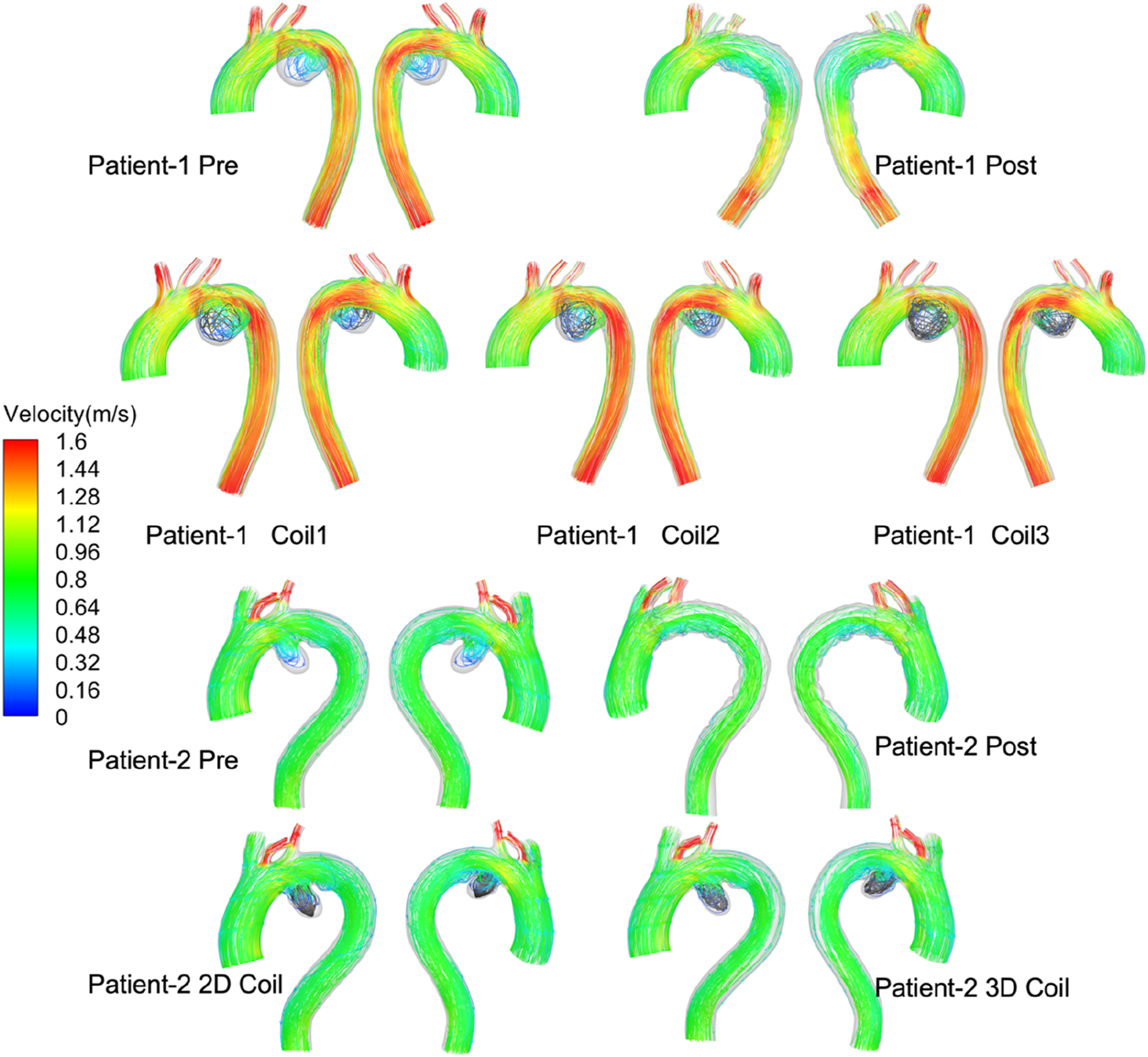 Series of diagrams showing blood flow velocity in the aortas of two patients, before and after treatments. Each diagram is labeled with the patient number and treatment stage, using a color scale to indicate velocity in meters per second. The scale ranges from zero (blue) to one point six meters per second (red).