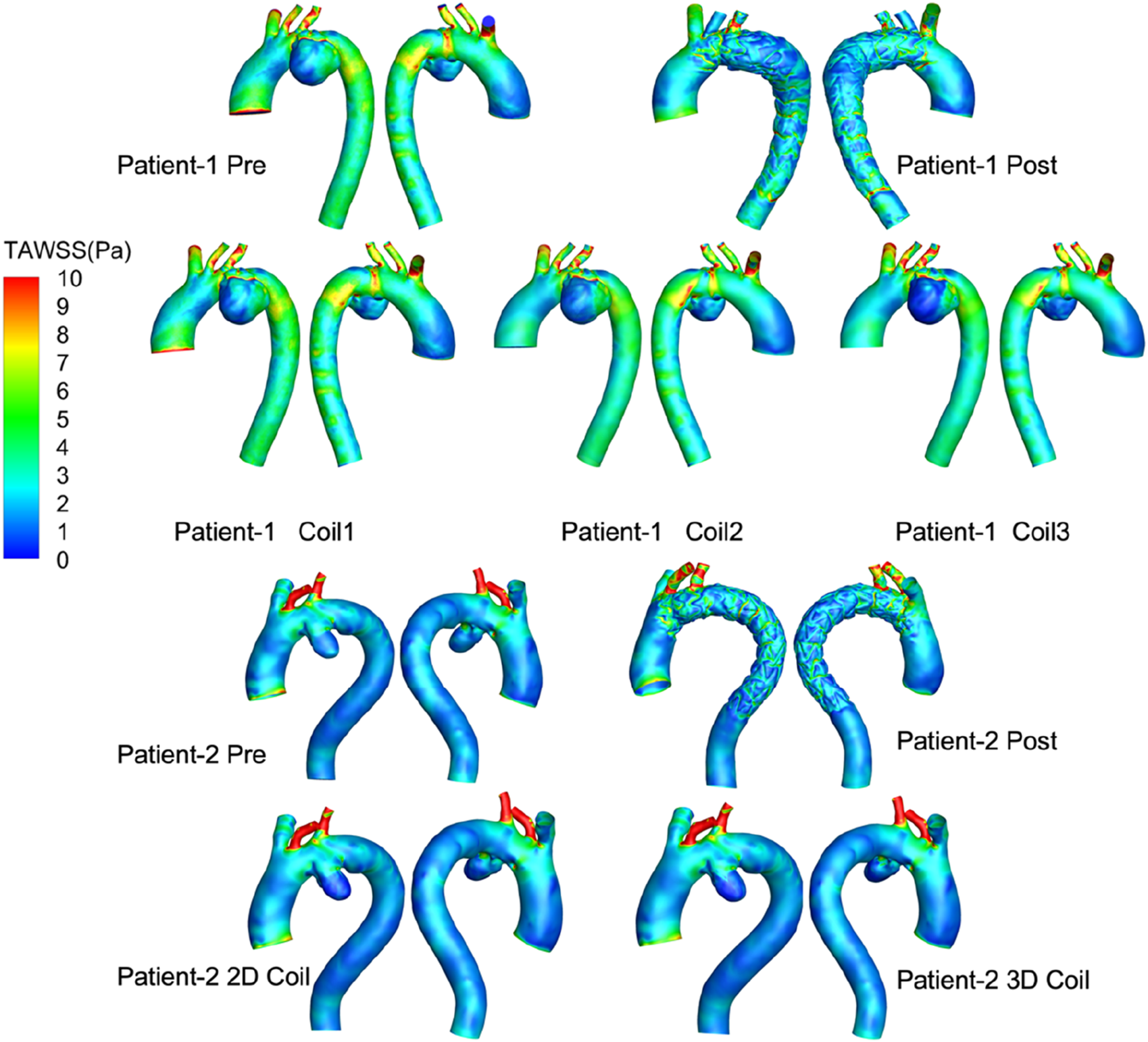 Visualization of blood flow simulations showing total area weighted shear stress (TAWSS) in pascals for two patients. Each patient has pre- and post-procedure models, with additional models using different coil configurations. The color scale ranges from blue (0 Pa) to red (10 Pa), illustrating varying shear stress levels across the vascular models.