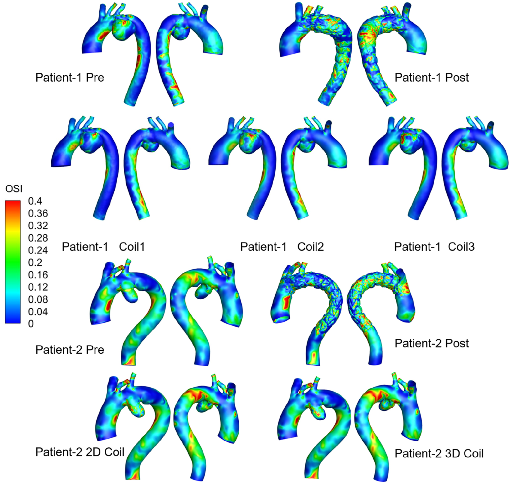 Medical visualization showing three-dimensional models of aorta blood flow for Patients 1 and 2, pre- and post-treatment. Color-coded by Oscillatory Shear Index (OSI), with a scale ranging from 0 to 0.4, indicating variations in flow. Different coil models are compared for both patients.