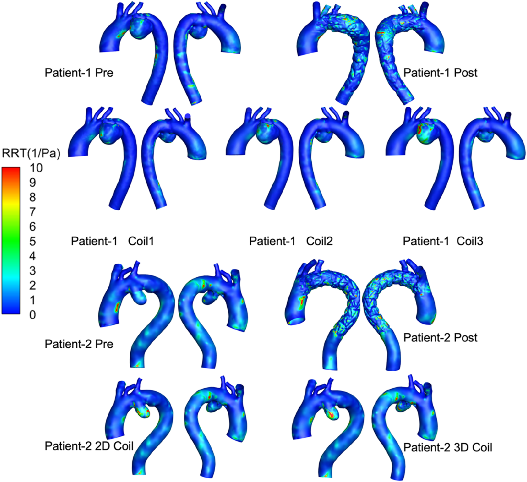 3D visualizations show aortic regions for two patients, using color mapping to indicate relative residence time (RRT) from 0 to 10 1/Pa. Top row displays Patient-1 pre and post-treatment, and with three coil variations (Coil1, Coil2, Coil3). Bottom row shows Patient-2 pre and post-treatment, with 2D and 3D coil configurations. Blue represents low RRT, transitioning to red for high RRT.