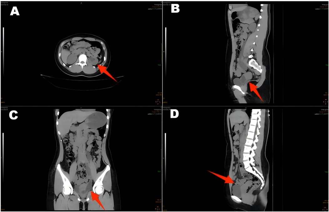 CT scan images showing axial, sagittal, and coronal views of the abdomen and pelvis. Red arrows indicate specific areas of interest in each section. Panel A displays the axial view, panel B the sagittal view, panel C the coronal view, and panel D another sagittal view.