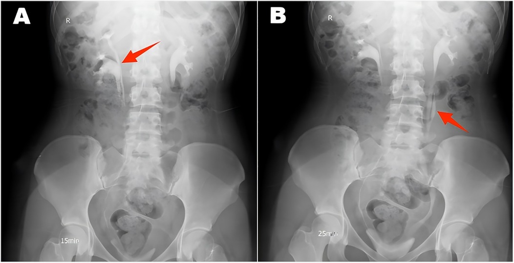 X-ray images labeled A and B show an abdomen with red arrows pointing at specific areas. Image A, timed at fifteen minutes, highlights a region near the spine. Image B, timed at twenty-five minutes, indicates another area nearby.