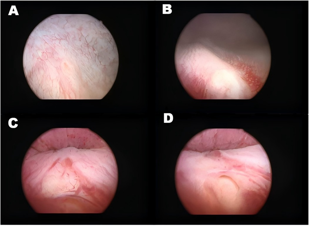 Four endoscopic images labeled A to D show varying views of the internal surface of what appears to be a human organ. Image A shows a pale surface with visible blood vessels, B displays a slightly darker shade with possible inflammation, C reveals a pinkish surface with more pronounced structures, and D exhibits a smoother, lighter pink texture.