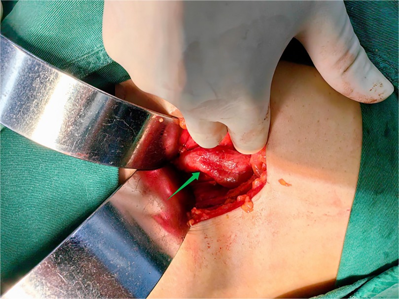 Surgical procedure showing a gloved hand holding tissue in an open wound, with a green arrow indicating a specific area. Metal retractors and surgical drapes are visible.