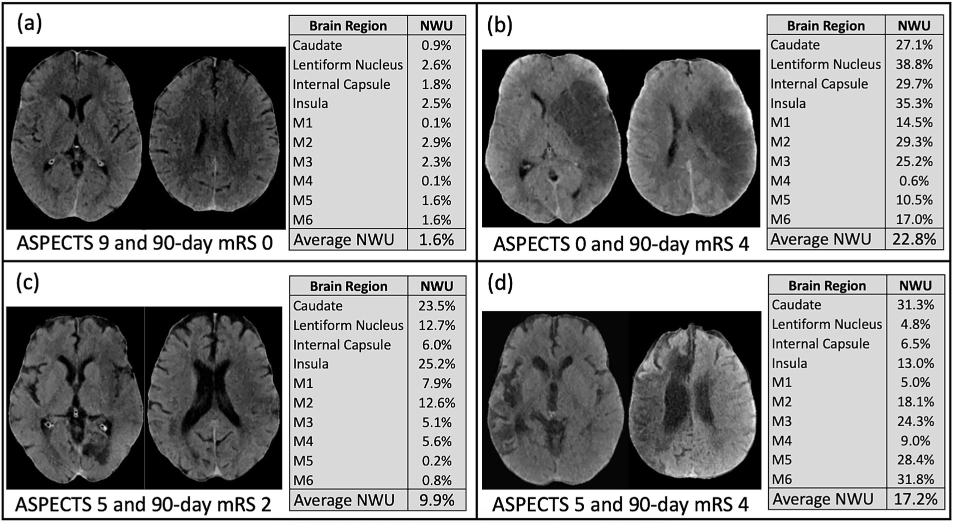 Four-panel image showing brain CT scans with corresponding ASPECTS scores and 90-day mRS outcomes. Each panel displays CT images and a table listing NWU percentages for different brain regions. Panels are labeled (a) ASPECTS 9, mRS 0; (b) ASPECTS 0, mRS 4; (c) ASPECTS 5, mRS 2; (d) ASPECTS 5, mRS 4. Each panel has a different average NWU value indicating the extent of brain changes.