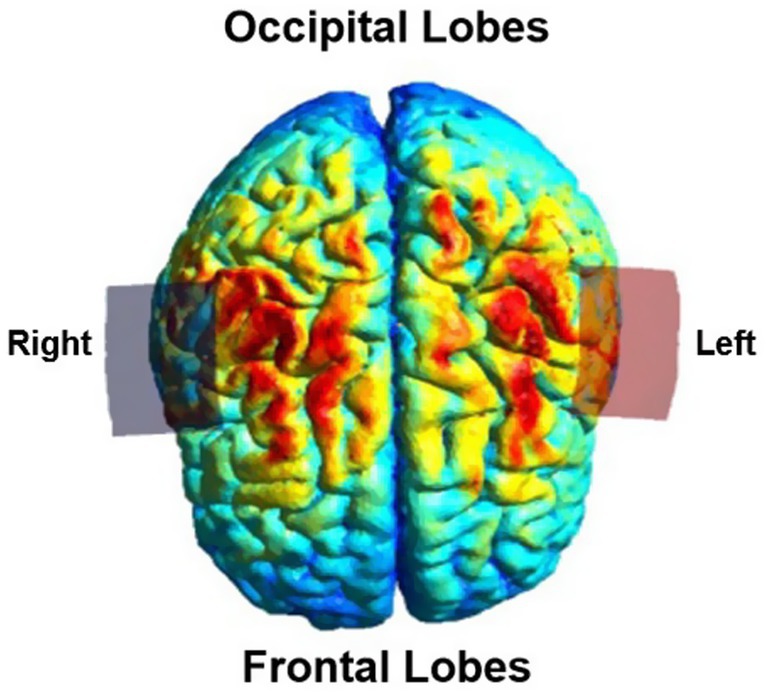 Computer generated top view of a human brain. The occipital lobes are labeled at the top, and the frontal lobes at the bottom. Left and right hemispheres are indicated on respective sides. The location of electrodes are marked.