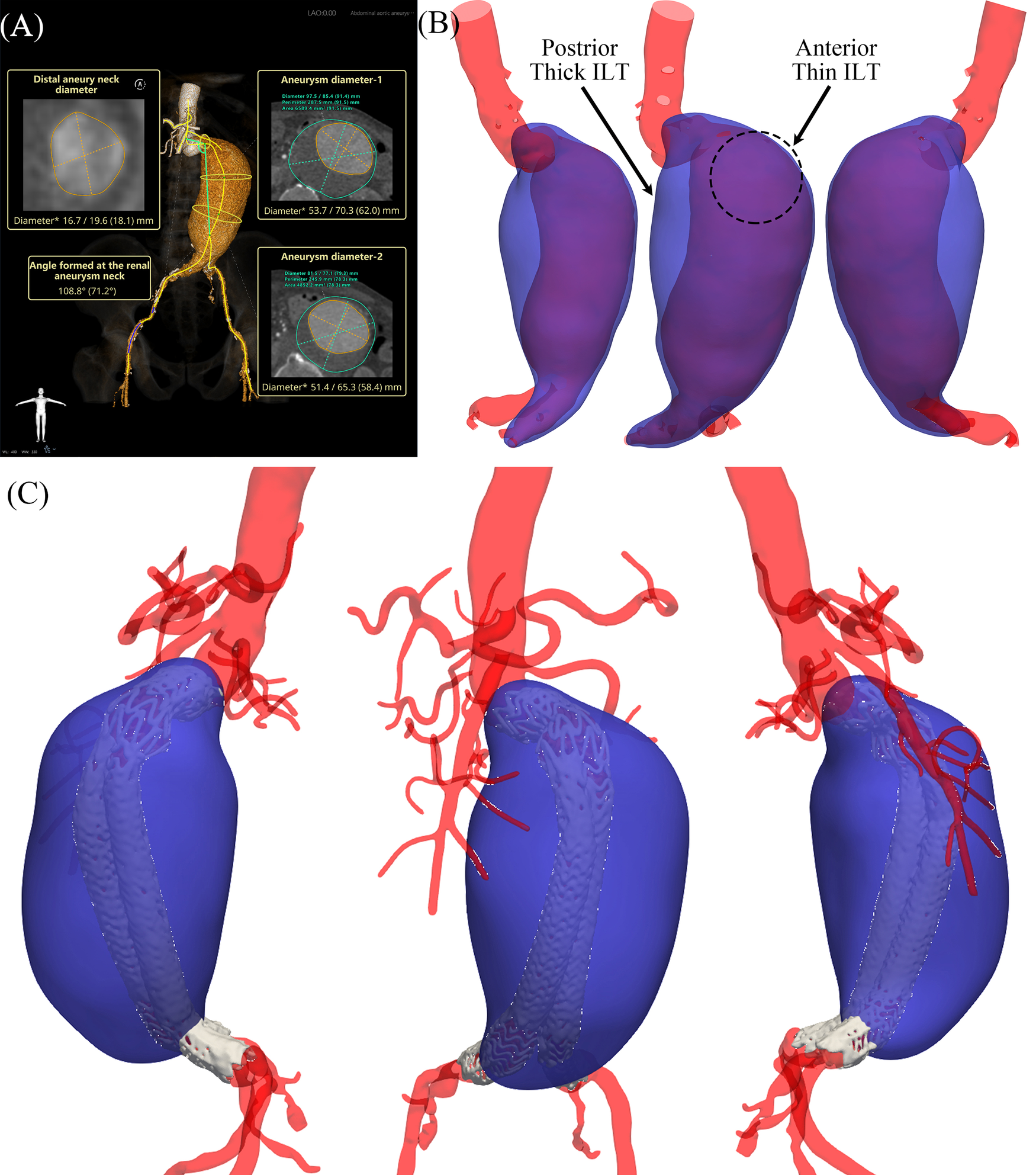 A three-part medical illustration depicts abdominal aortic aneurysms. (A) Features CT scan images showing measurements of aneurysm diameters and angles at the renal aneurysm neck. (B) Displays 3D models of aneurysms with labeled posterior thick and anterior thin intraluminal thrombus (ILT). (C) Shows additional 3D representations with highlighted blood vessels and thrombus formations. The models use color coding to differentiate between blood vessels and thrombus within the aneurysms.