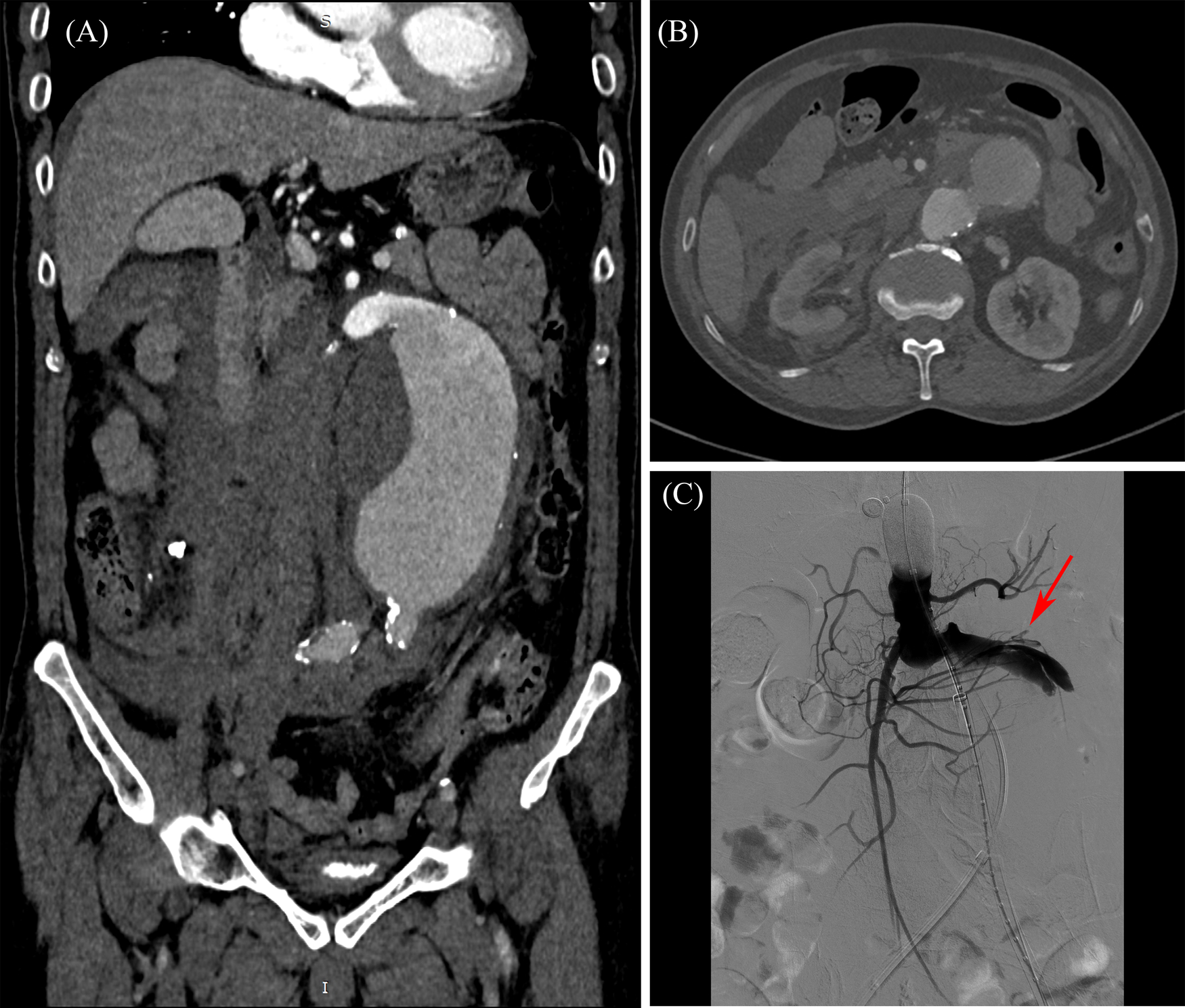 (A) Coronal CT scan showing abdominal aortic aneurysm with contrast enhancement. (B) Axial CT scan showing abdominal aortic aneurysm. (C) Angiogram highlighting a vascular structure with an arrow pointing to the rupture sites.