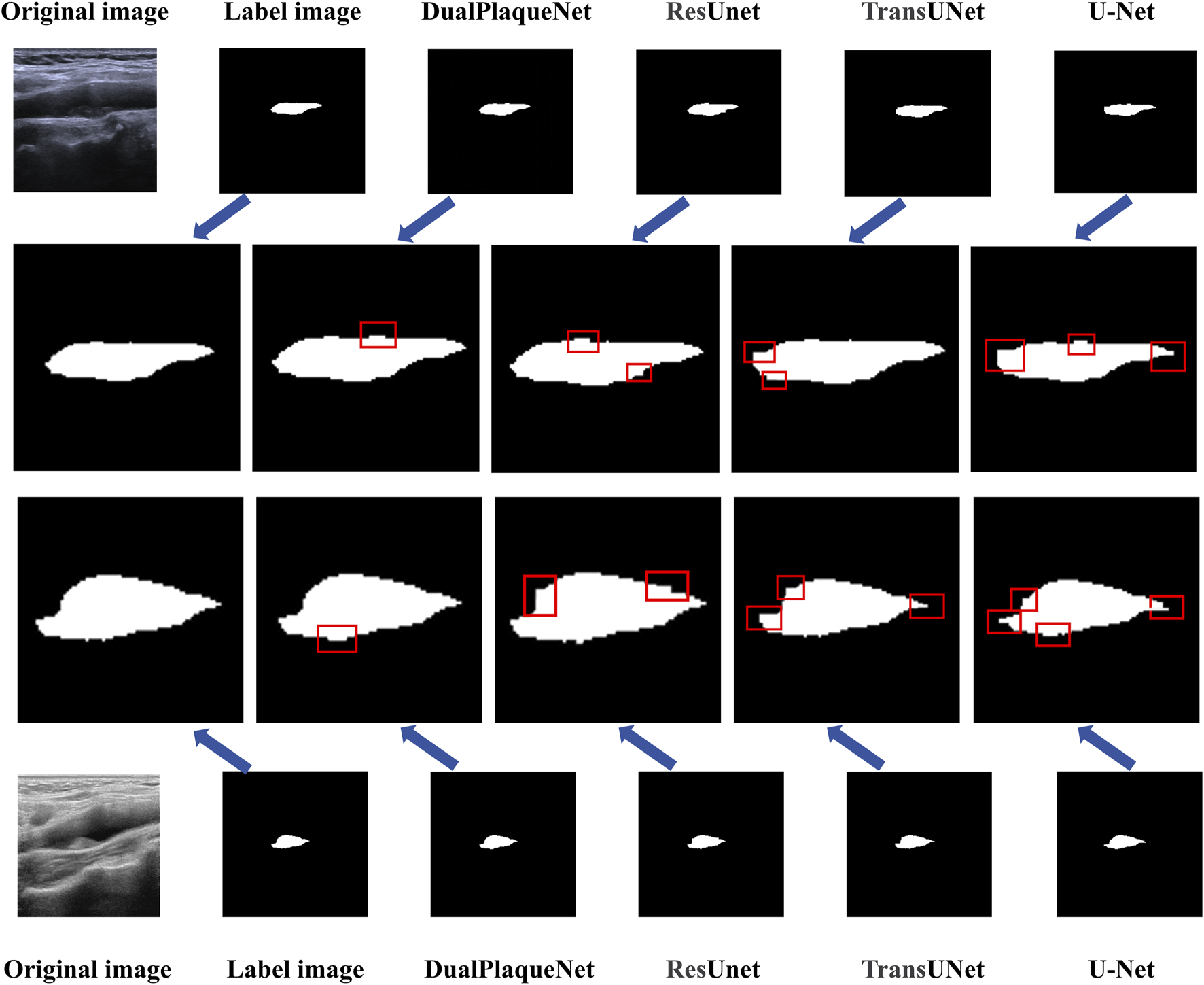 Ultrasound images show original scans alongside labeled images and segmentation results from DualPlaqueNet, ResUnet, TransUNet, and U-Net models. The segmentations highlight areas of interest in white, with differing accuracy and details marked in red boxes.